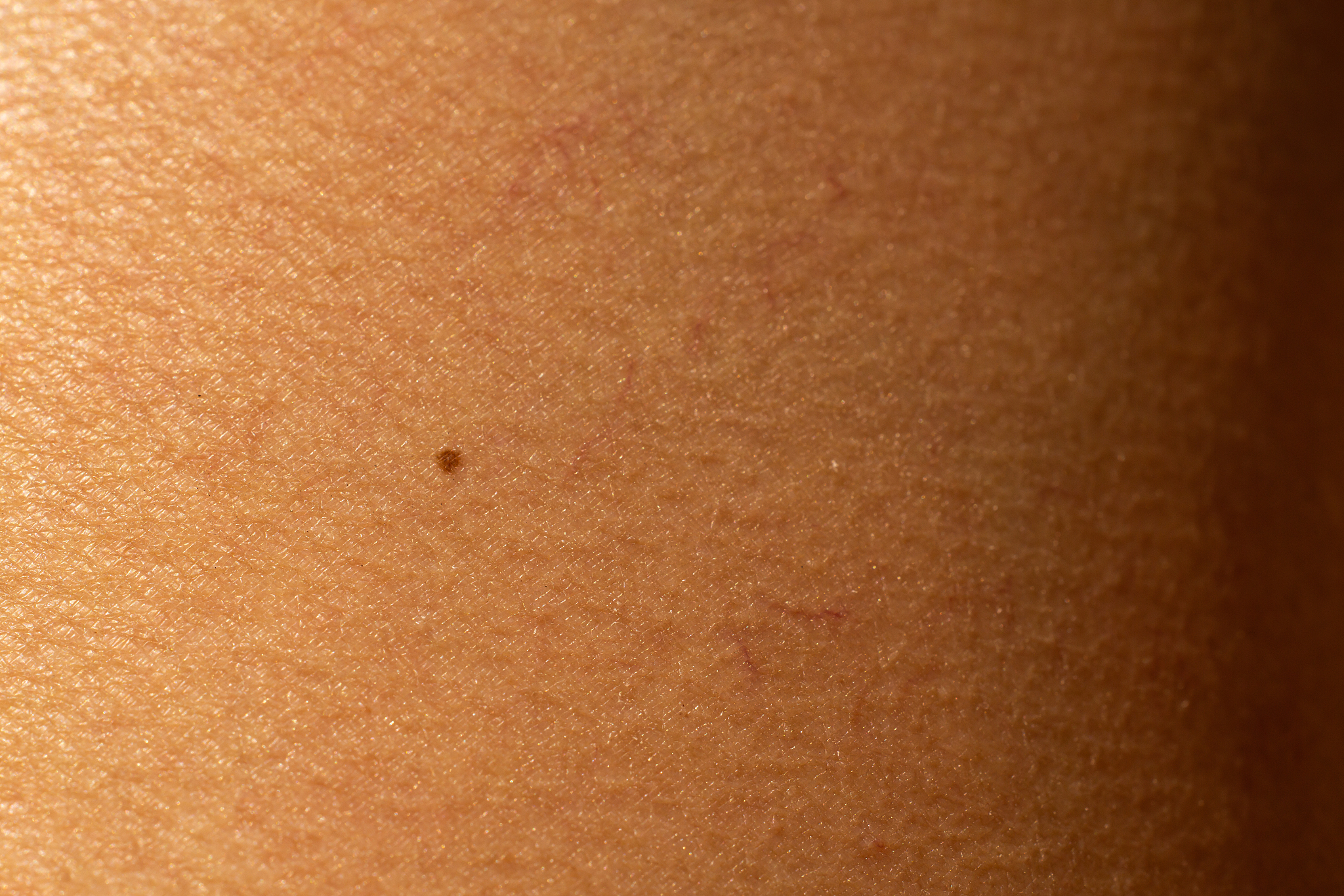 brown mole on woman's leg, medicine, close up & macro shot, sele