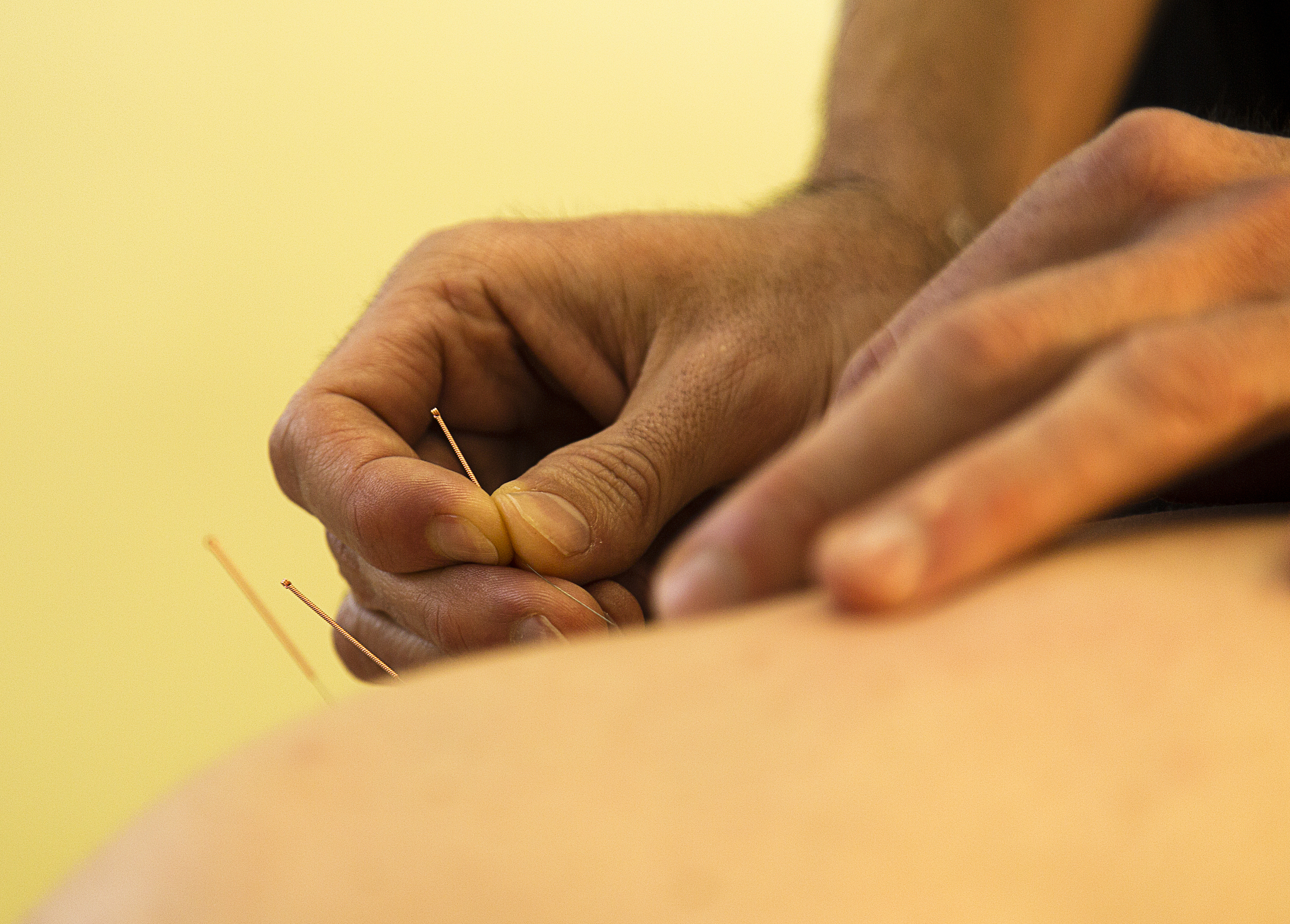 女子看中医针灸惊呆！满身针灸针引争议，你敢尝试吗？