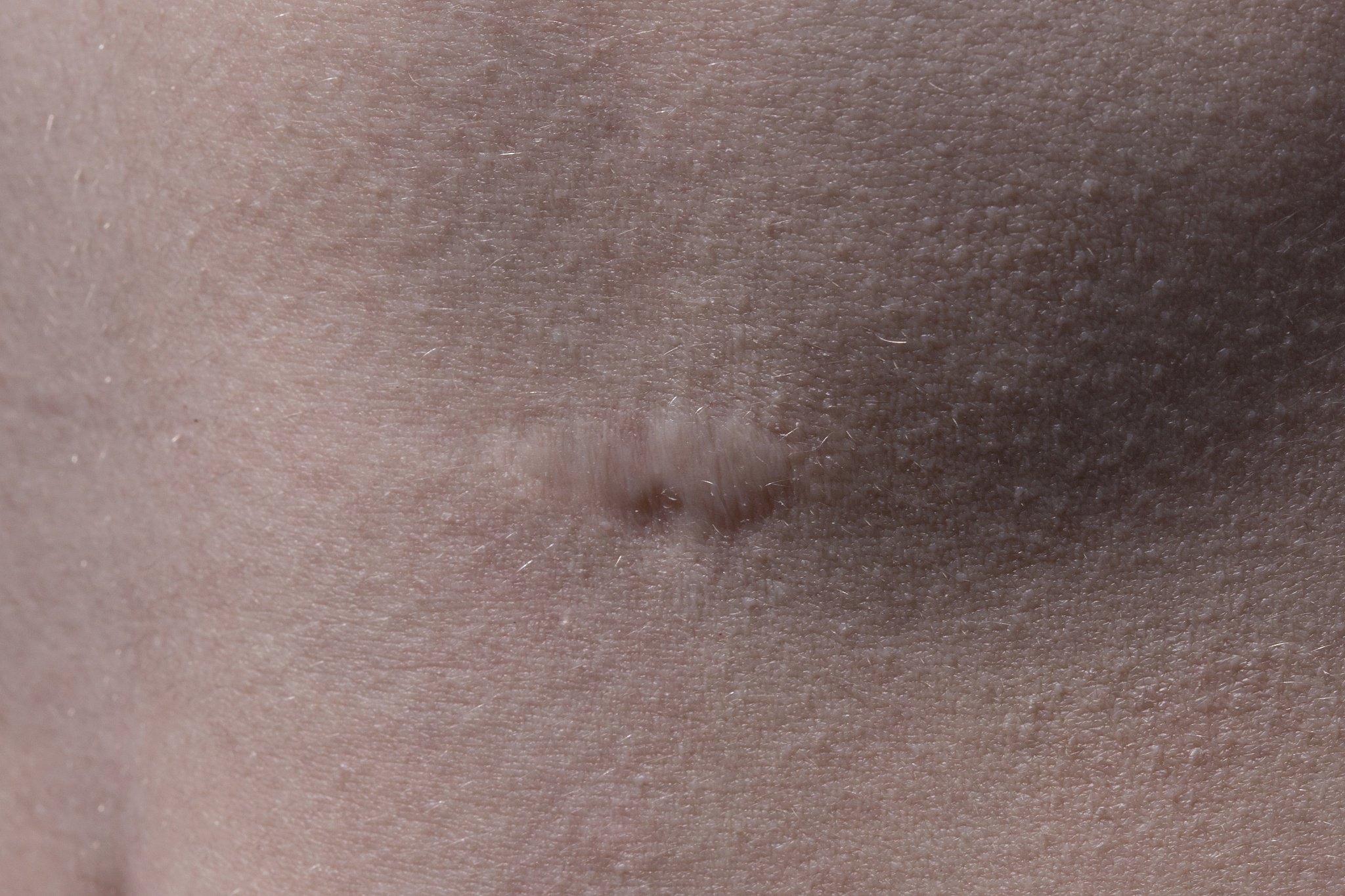 texture of skin with scar
