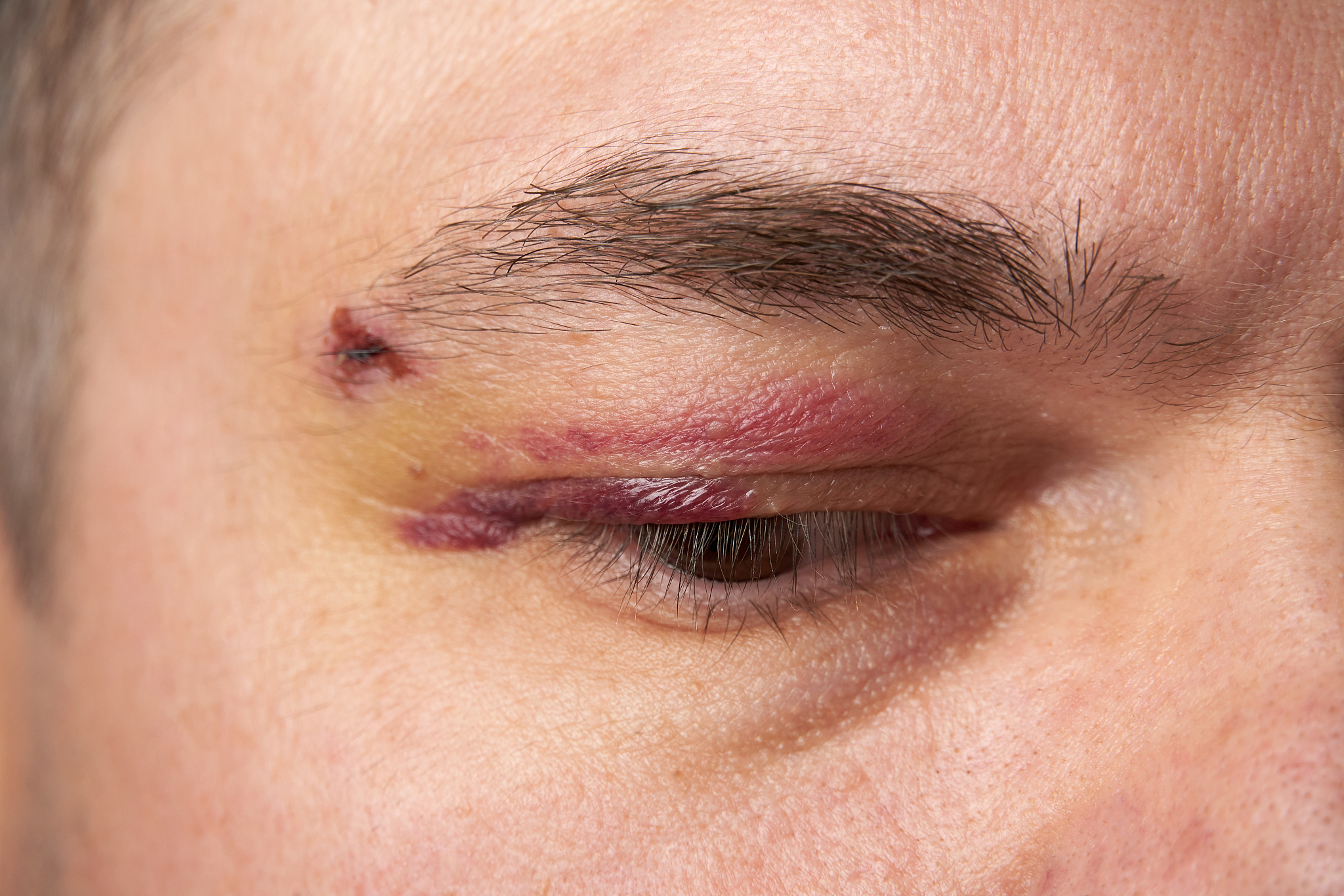 眉毛纹后变红怎么办？一年内变红的原因及处理方法