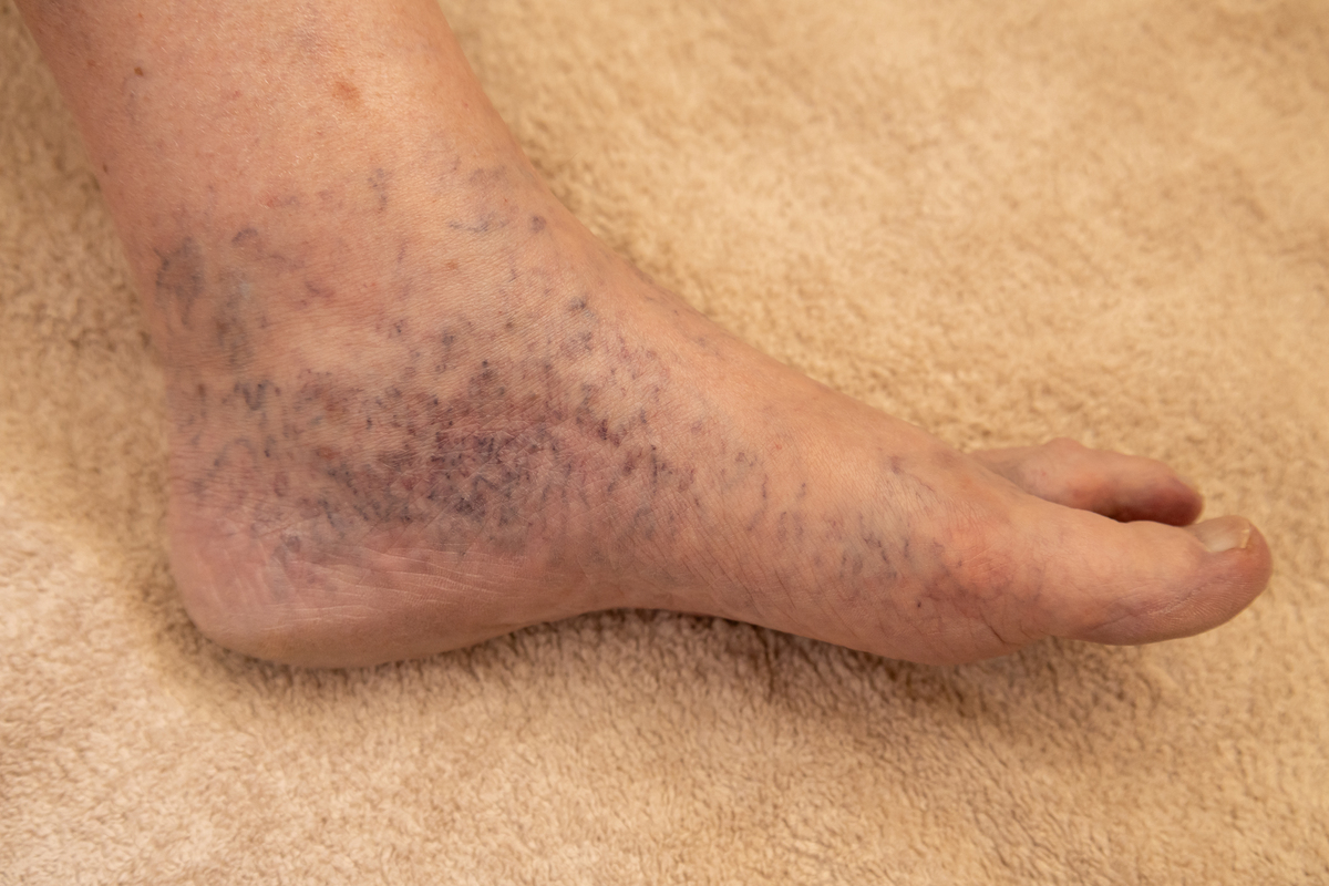 关于静脉曲张病的感受总结要1500字