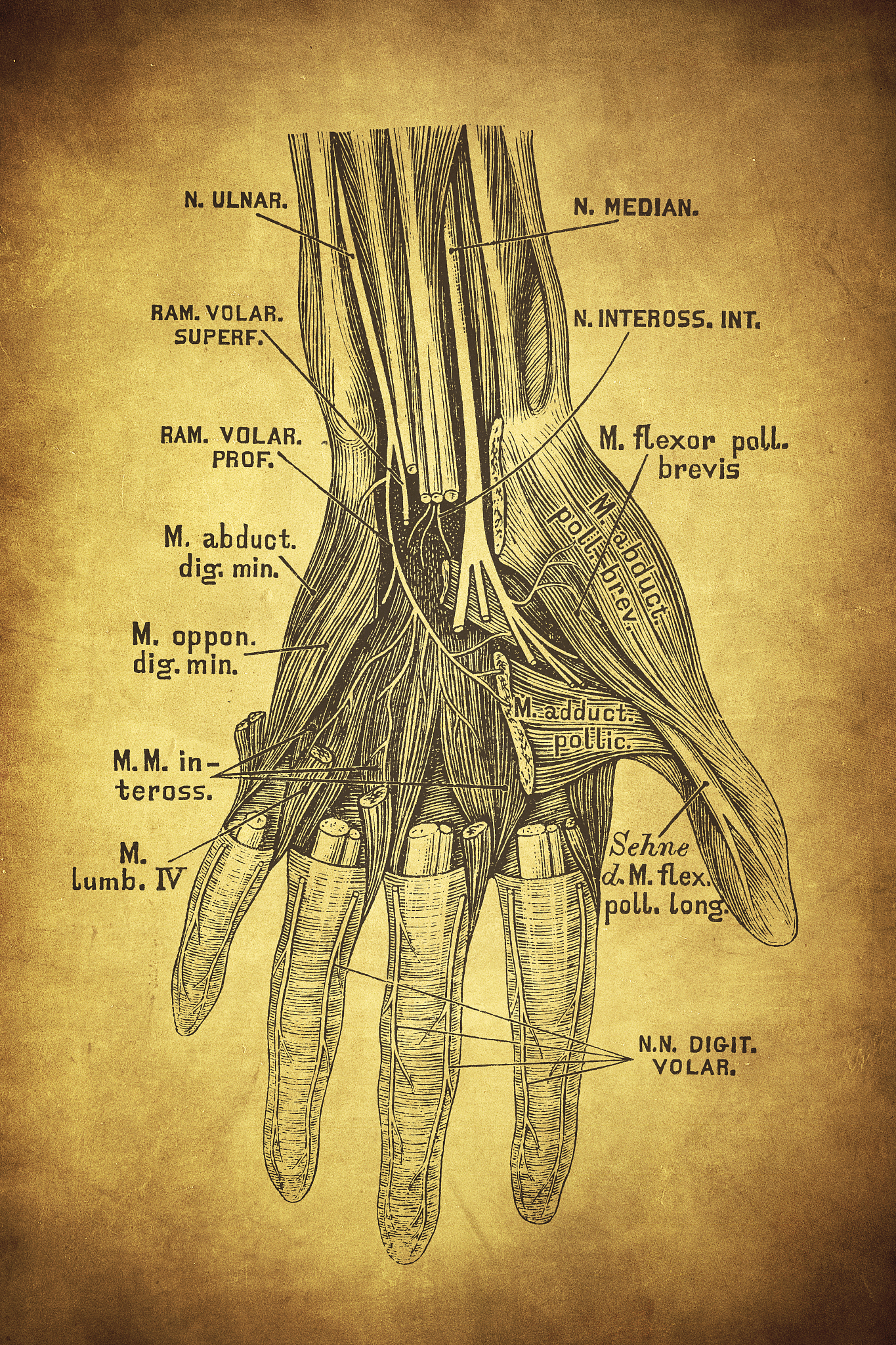 检查结果是这样的1、双侧侧脑室前角旁白质轻度脱髓鞘;2、头颅MRA双侧颈内动脉海绵窦段轻度硬化多考虑;3、双侧下鼻甲肥厚左侧上颌窦粘膜下囊肿多考虑身体自我感知：手指发麻请形容一下我的病情