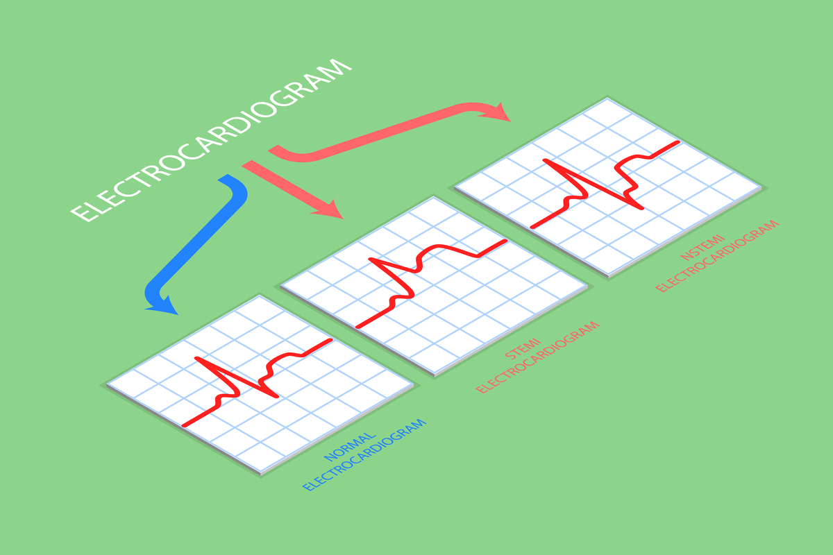 对以下文字进行重写对下面文字进行降重小波变换技术在提升 Q 波检测的准确性方面表现出了良好的性能。根据小波变换理论R 波峰与 模最大模数最小值的零点具有稳定的位移关系。 因此使用小波变换来检测 QRS 波是通过定位 R 波的方法的最大值的模数来检测 R 波从 R 峰值位置开始 选择较小的刻度向前和向后搜索 QRS 波开始和结束以避免 QRS 波的宽度失真。对于干扰严重或非典型 R 波的情况需提炼其