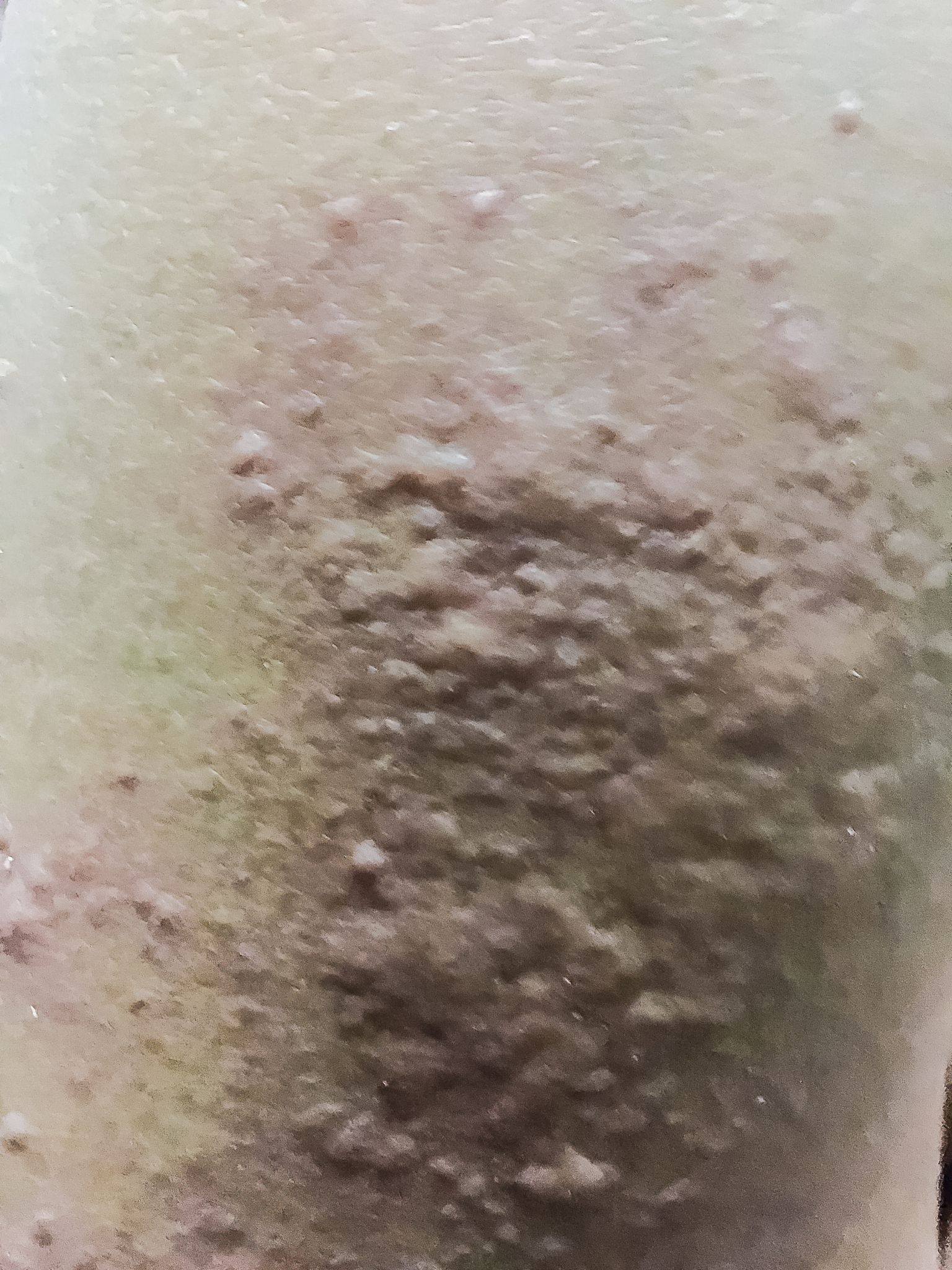 close up view of cold urticaria allergic rash. symptoms of itchy