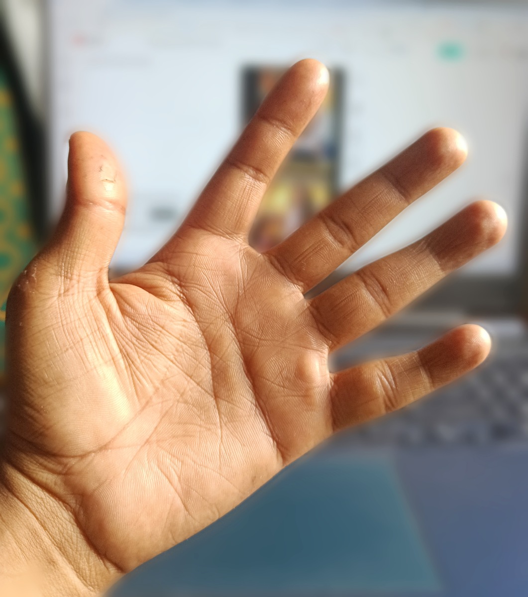 缺乏维生素导致手脱皮粗糙的症状