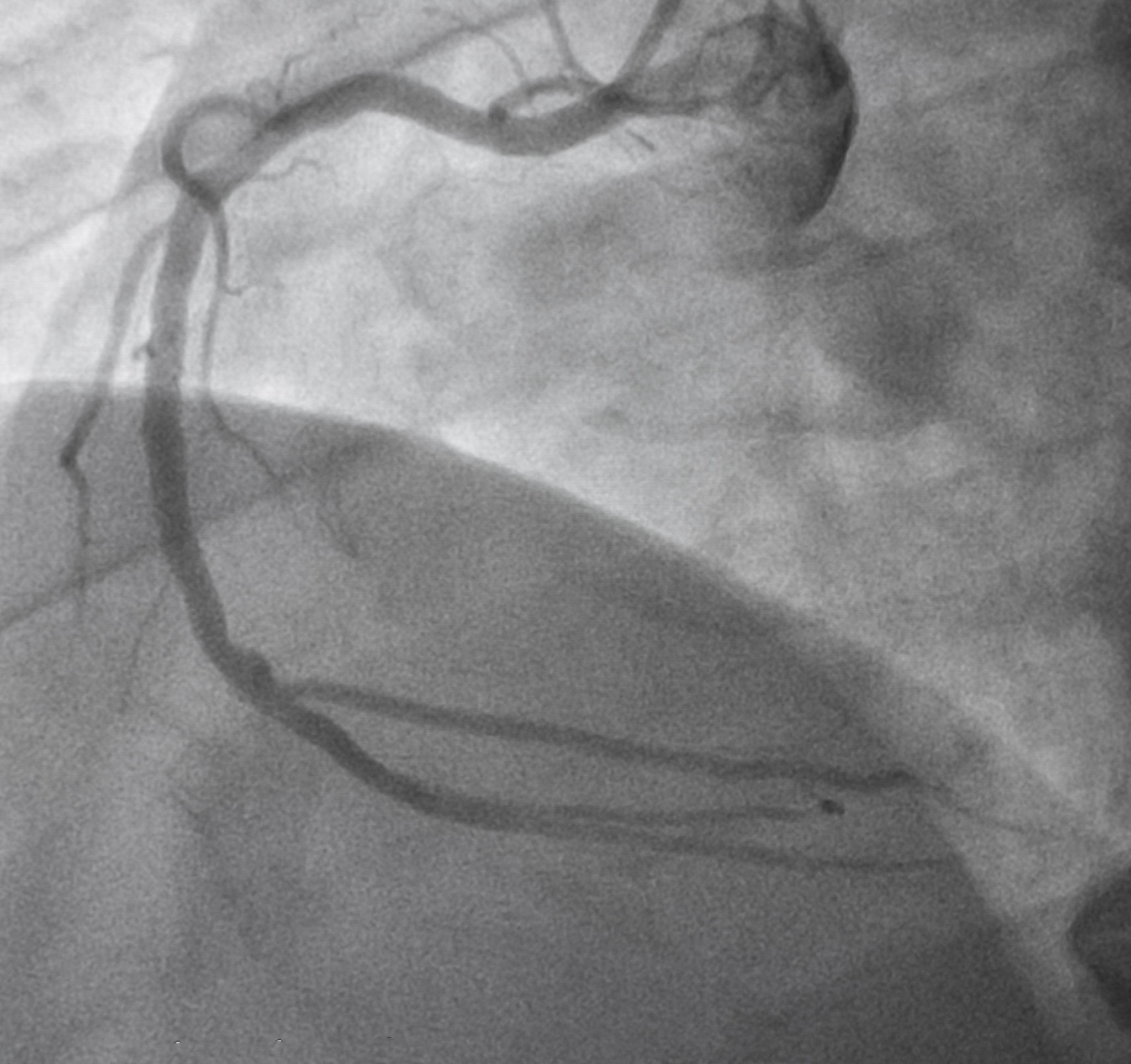 颈动脉CTA影像中的甜甜圈征：FFT解读