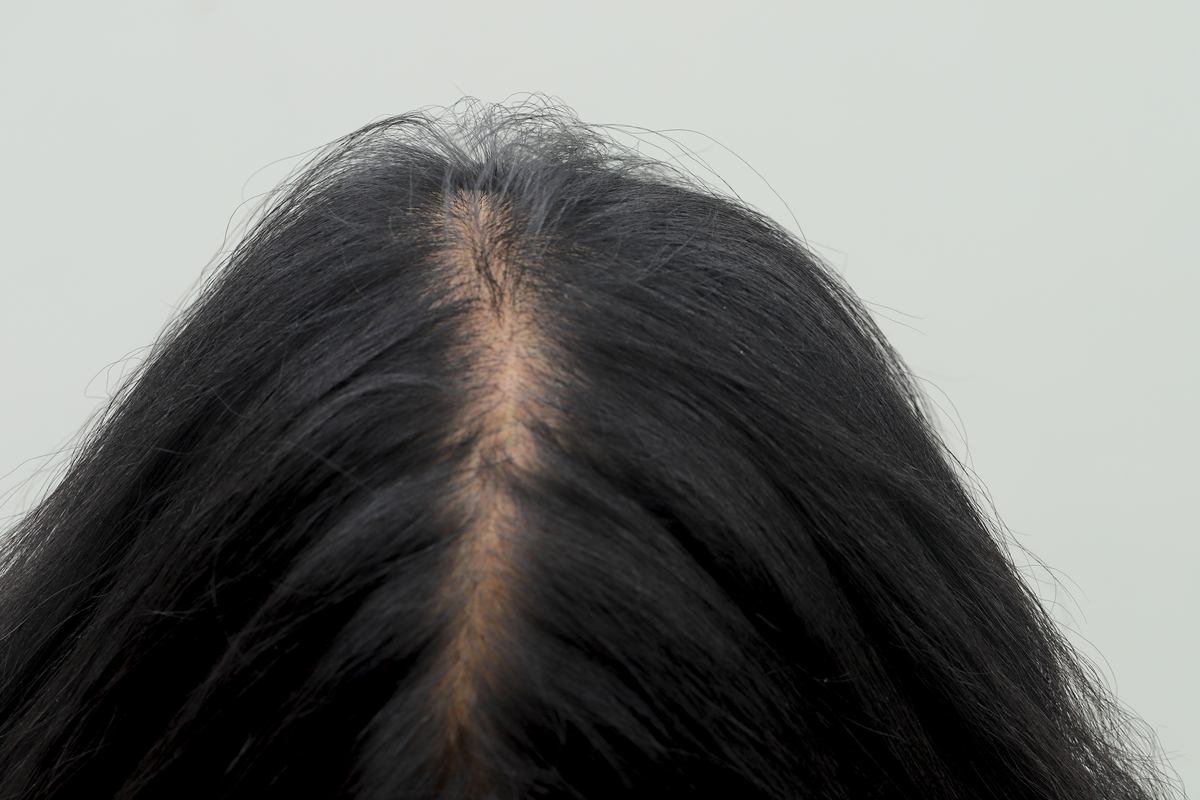 头发稀疏怎么办？改善稀疏头发的5个实用方法