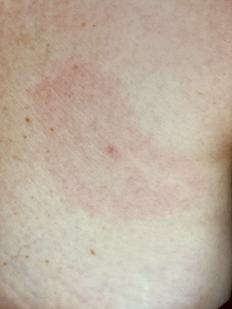 春季过敏大作战:你的皮肤,我来守护!