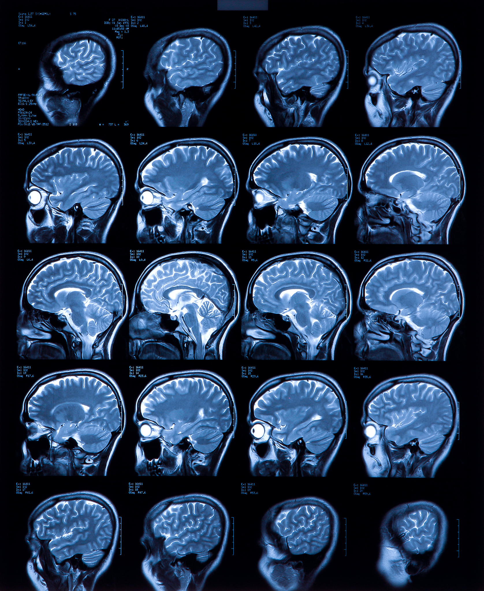 星形细胞瘤是如何形成的