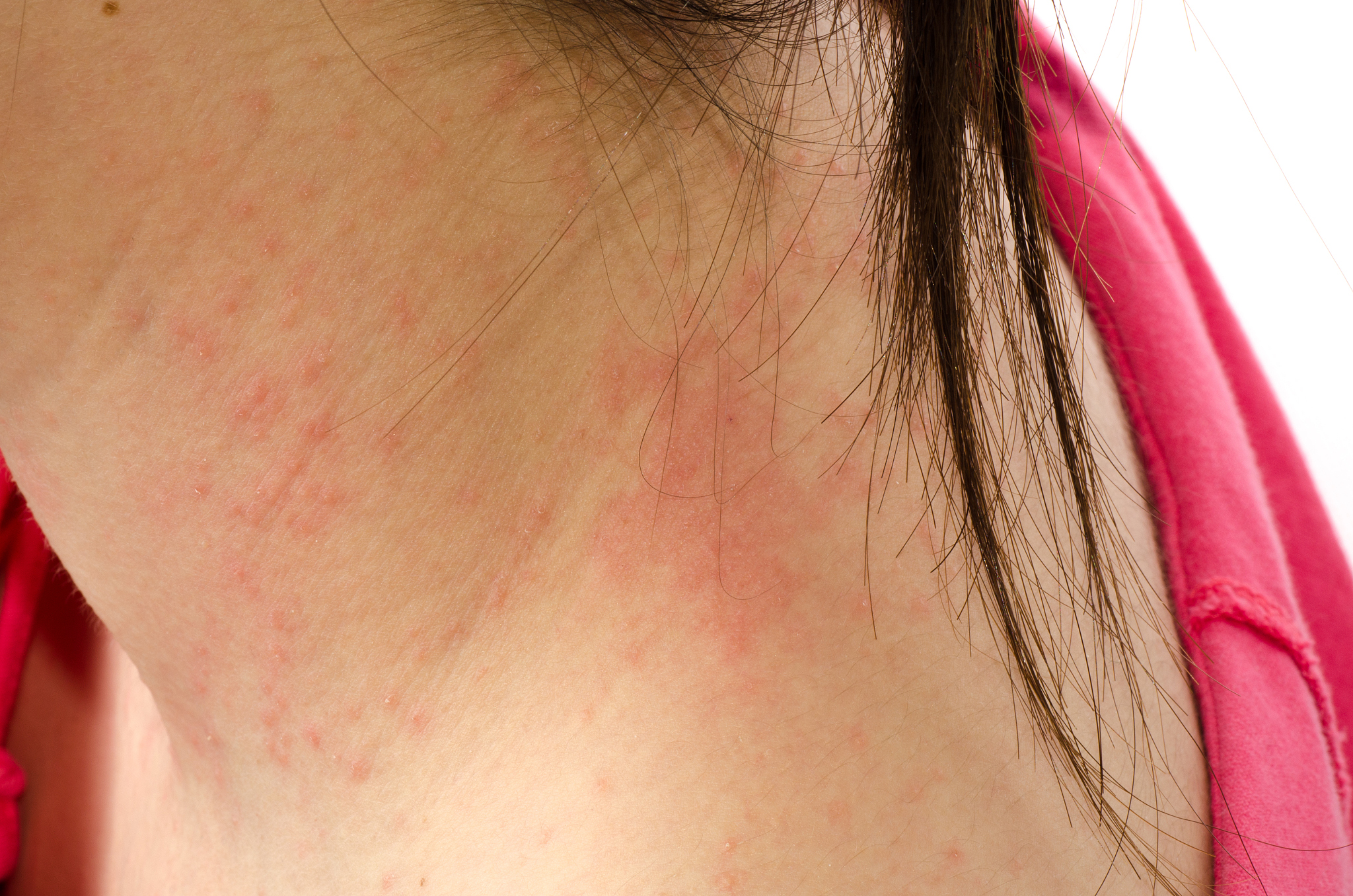 eczema skin on neck