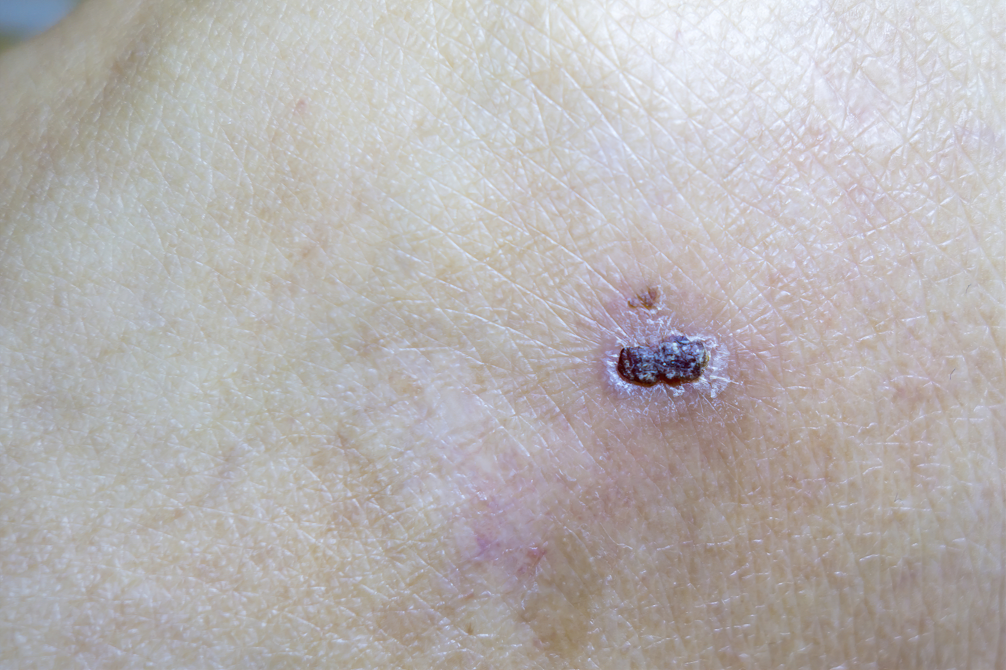 wound