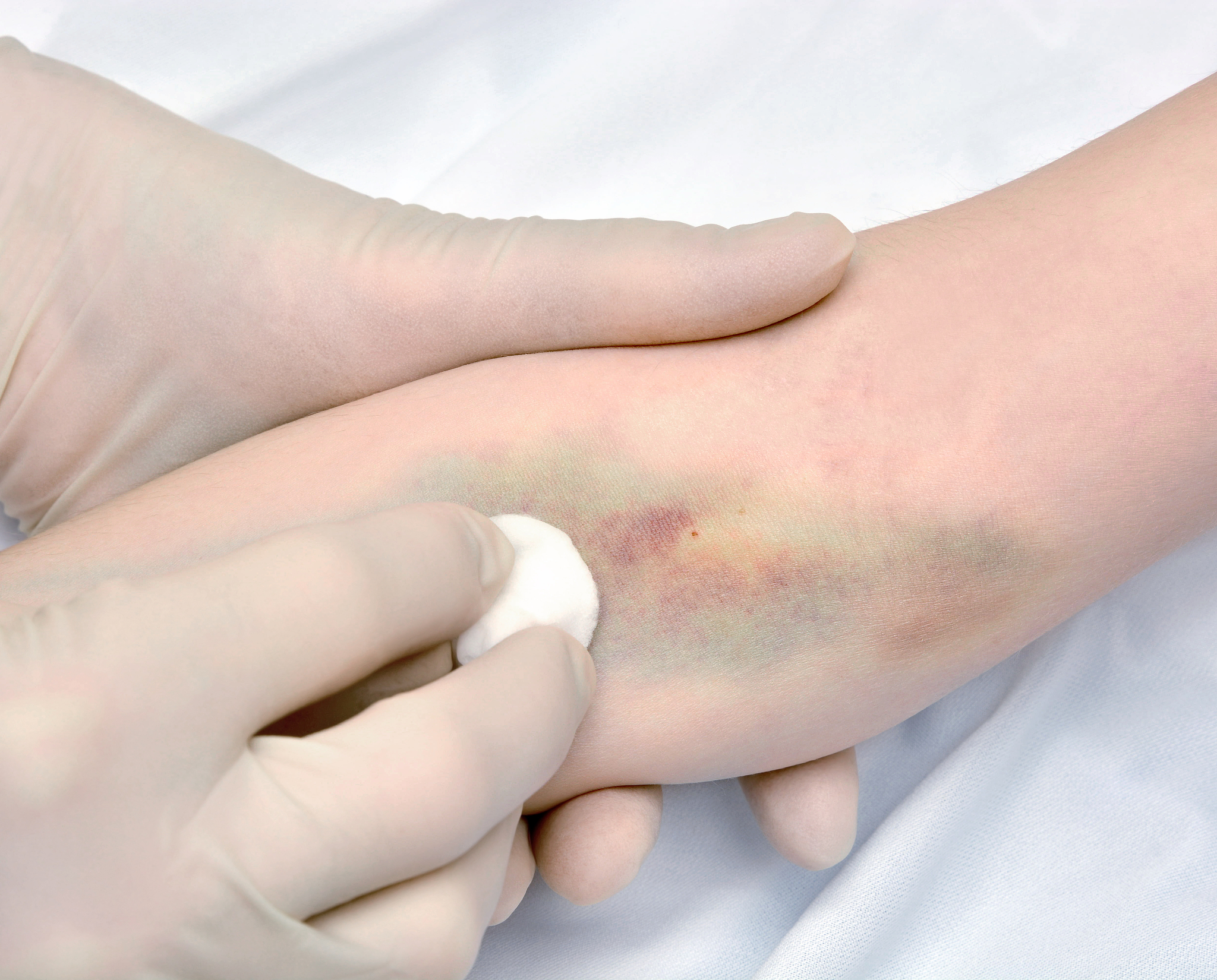 厄贝沙坦联合硝苯地平控释片治疗社区高血压患者效果显著