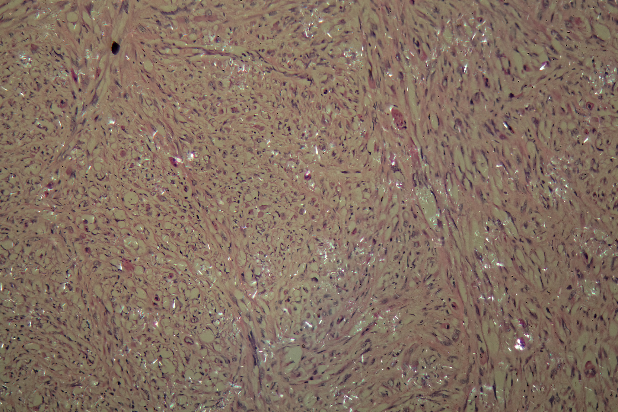 癌细胞在显微镜下的特点