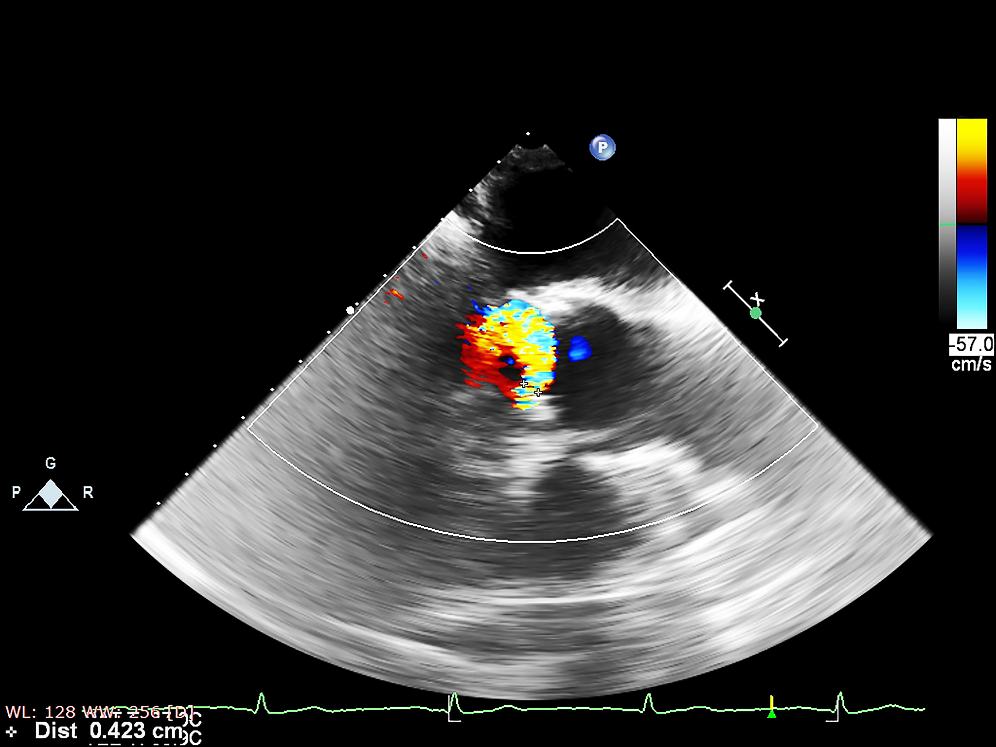 超声间质热消融技术：原理、适应症及应用前景