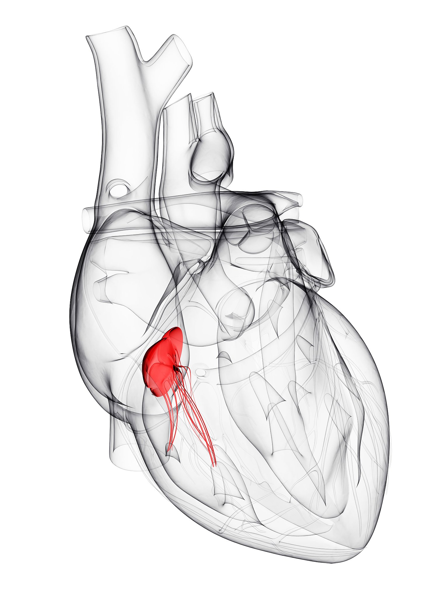 瓣周漏介入封堵术