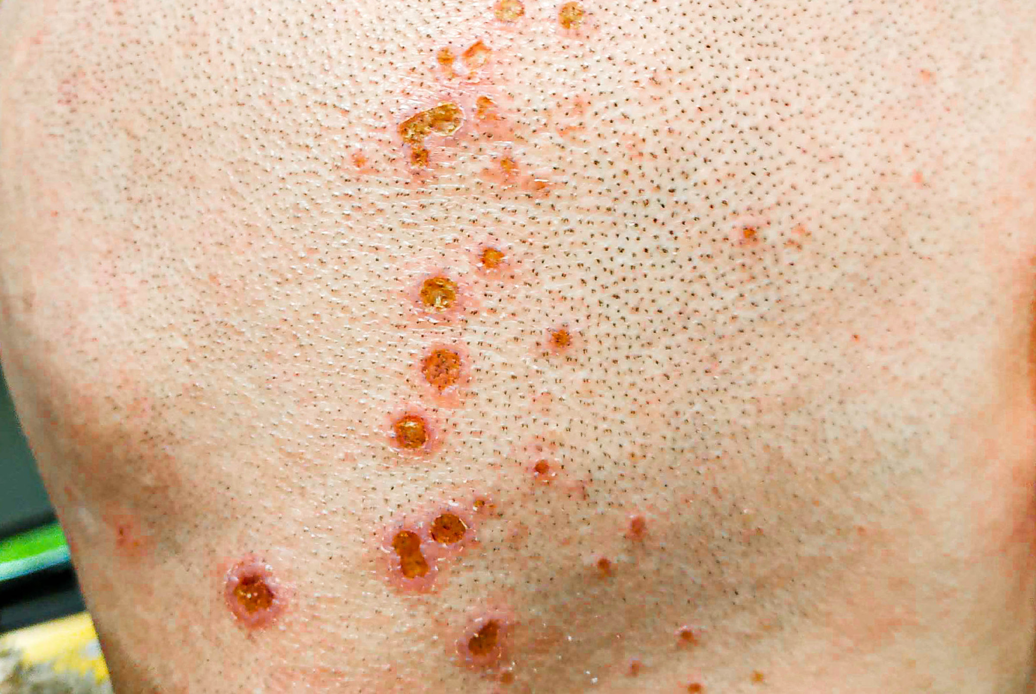 chemical burns on the head. wounds after hair dyeing. chemistry.