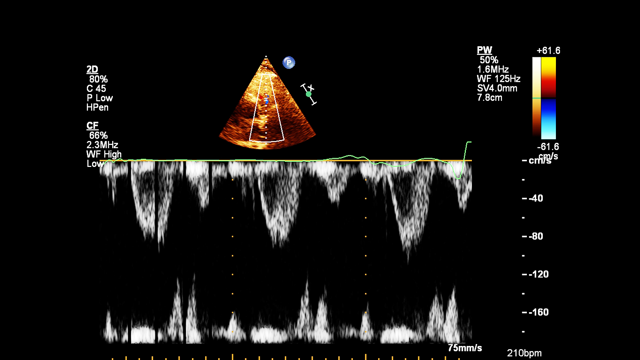 延迟分离涡模拟方法存在什么问题