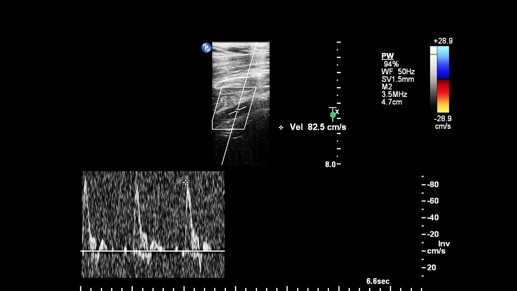 血管内超声诊断导管提高换能器的中心频率有什么项目必要性