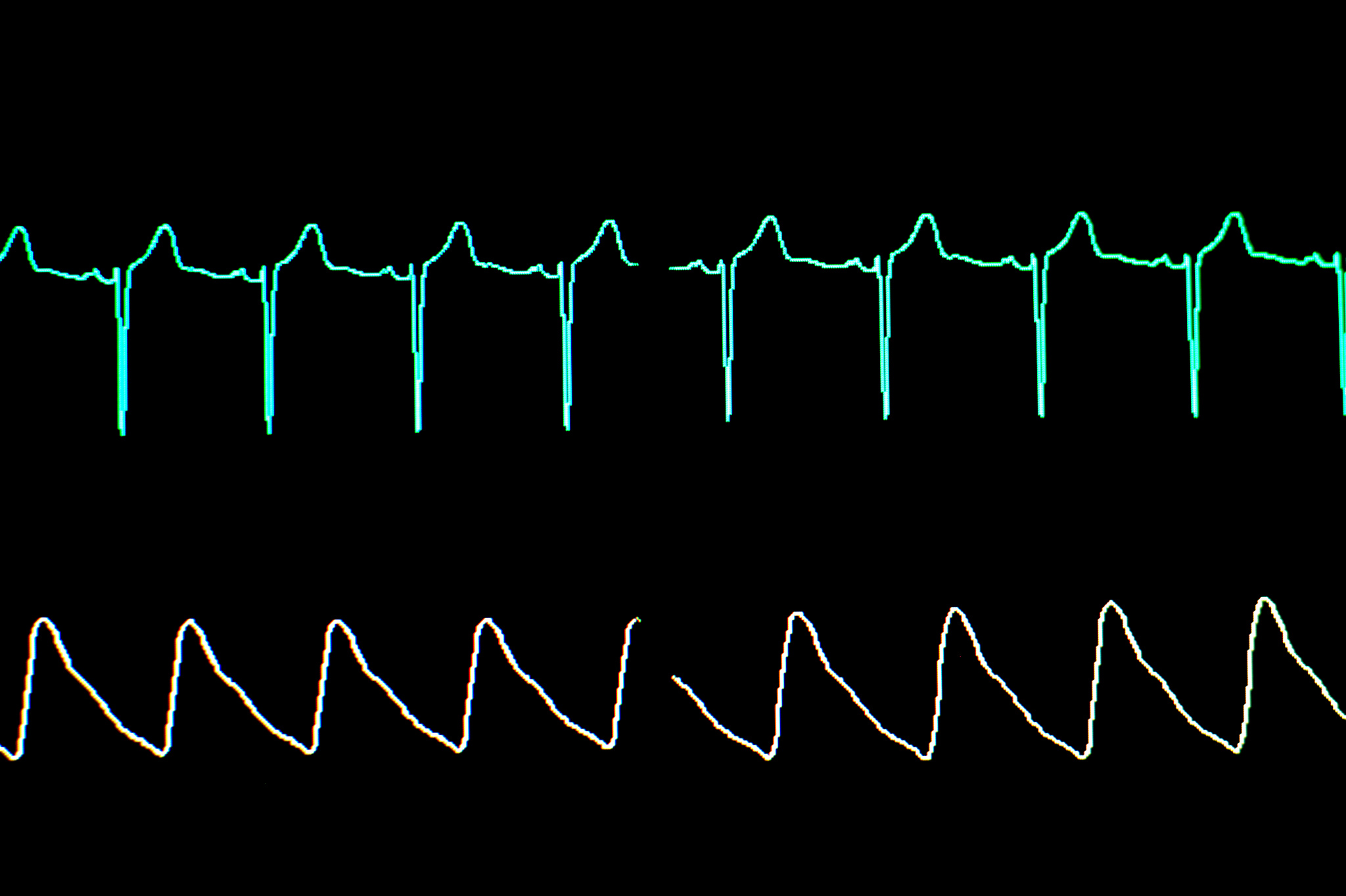 心电图时间常数与放大器带宽的关系