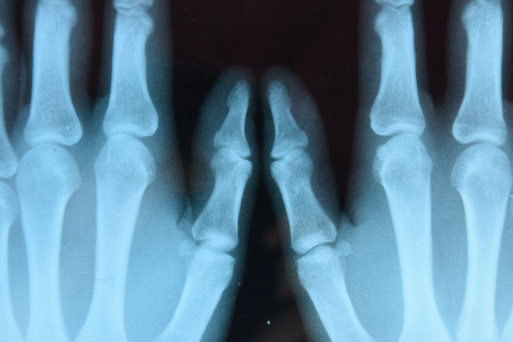 关节脱位类型中 复位及保持较 为困难的是臼骨后脱位因为臼骨后脱位时关节被卡住复位难度较大并且容易再次脱位。掌指关节呢？掌指关节也是容易脱位的关节之一特别是拇指掌指关节。由于手部经常进行各种动作和运动掌指关节容易受到外力伤害导致脱位。如果不及时进行复位和固定可能会导致手功能障碍和疼痛等问题。因此对于掌指关节的脱位要及时就诊并接受专业治疗。掌指关节复位及保持较为困难