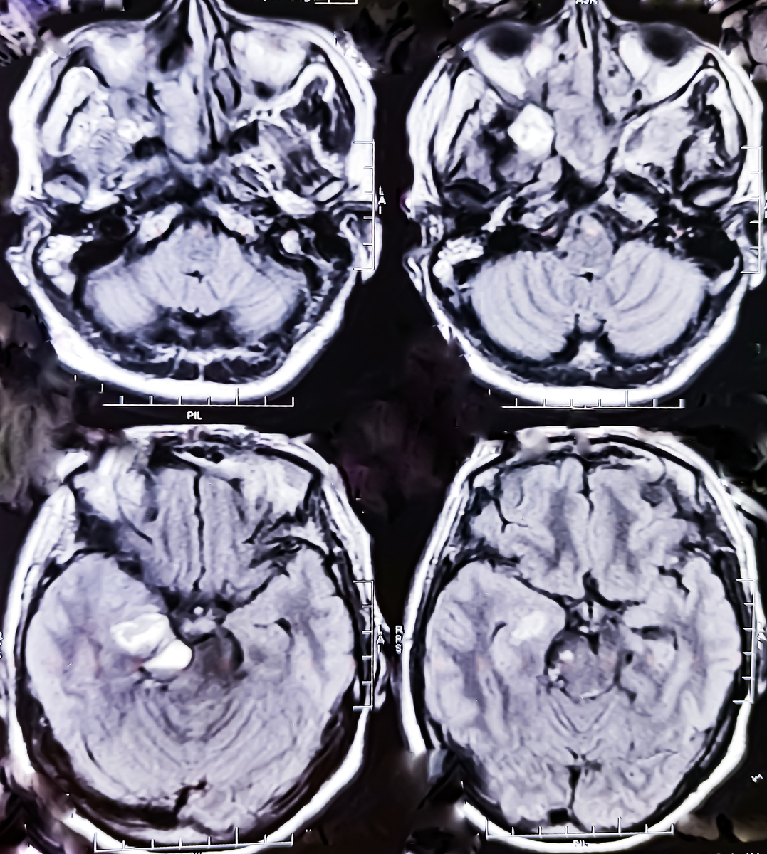 尾状核腔隙性脑梗死与神经精神症状的相关性：MRI 证实