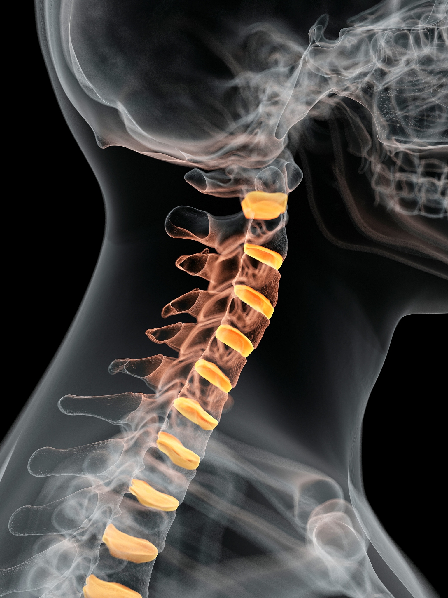 颈4、5椎体次全切手术治疗骨髓颈型颈椎病：缓解症状、恢复功能、预防并发症