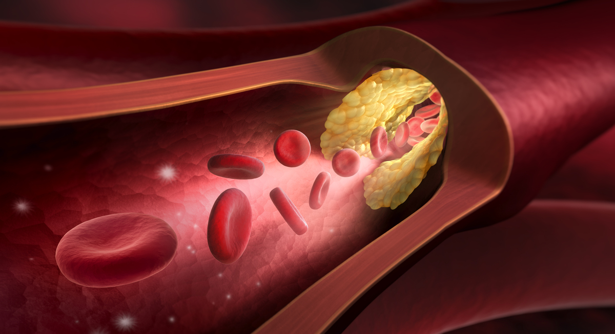 脂肪进入血液会导致眩晕吗？原因及症状解析