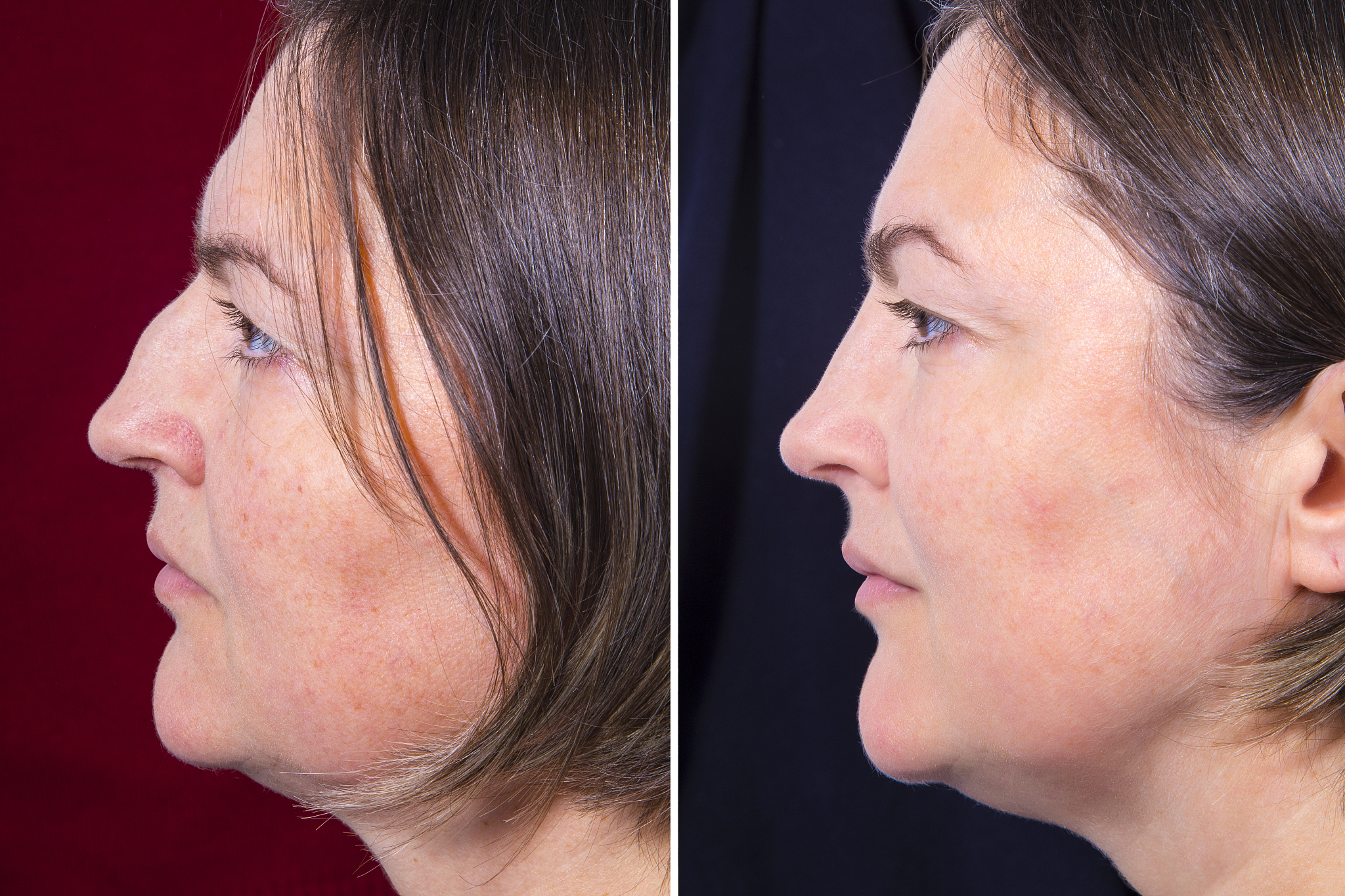 牙齿矫正会改变脸型吗？