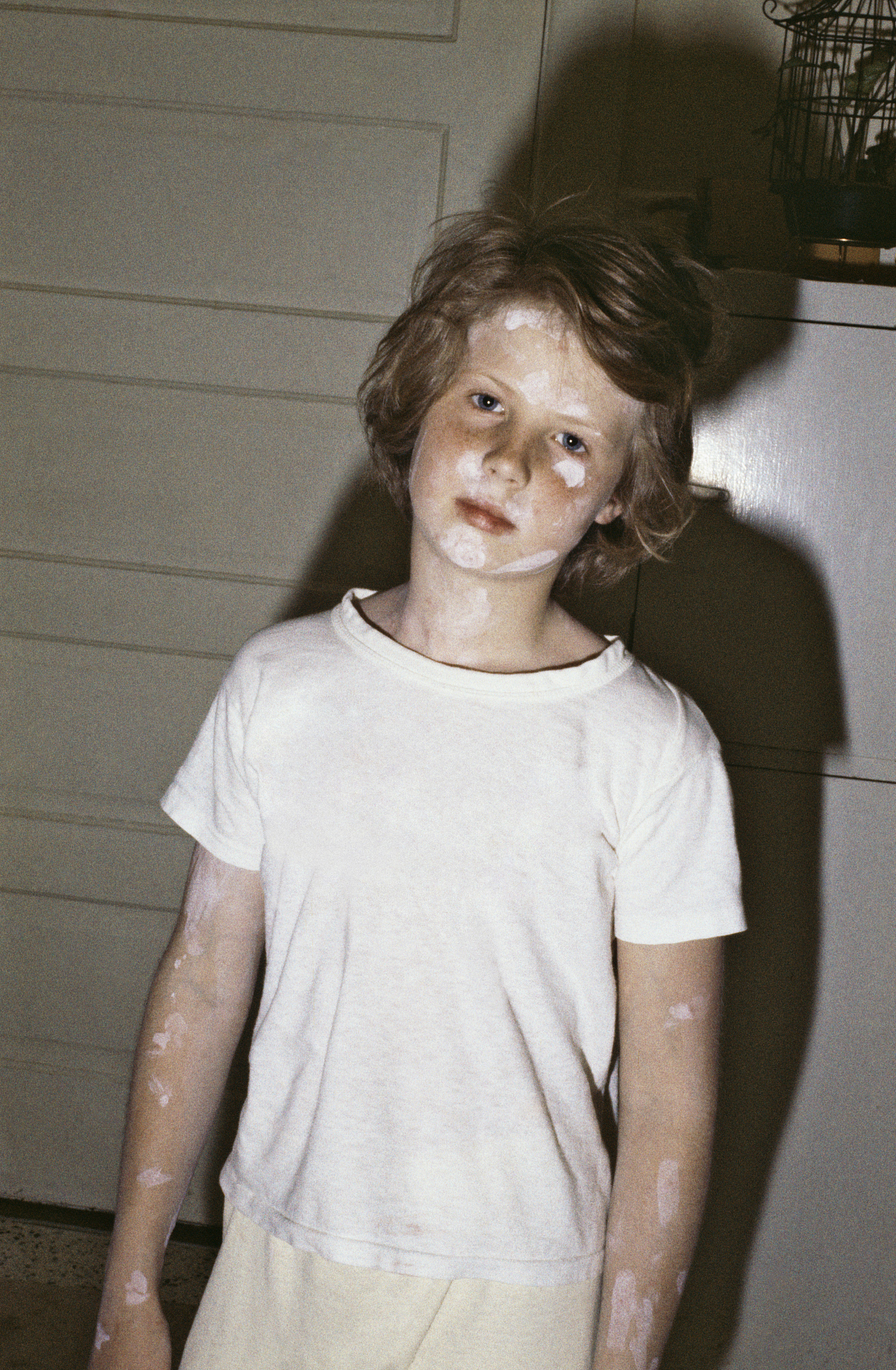girl with chickenpox