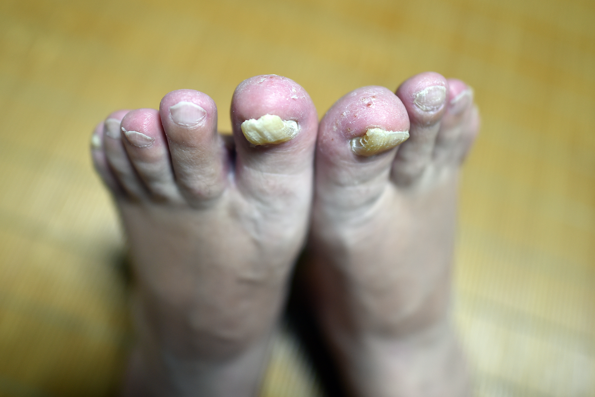 脚气是什么原因引起的？了解脚气真菌和其他病因