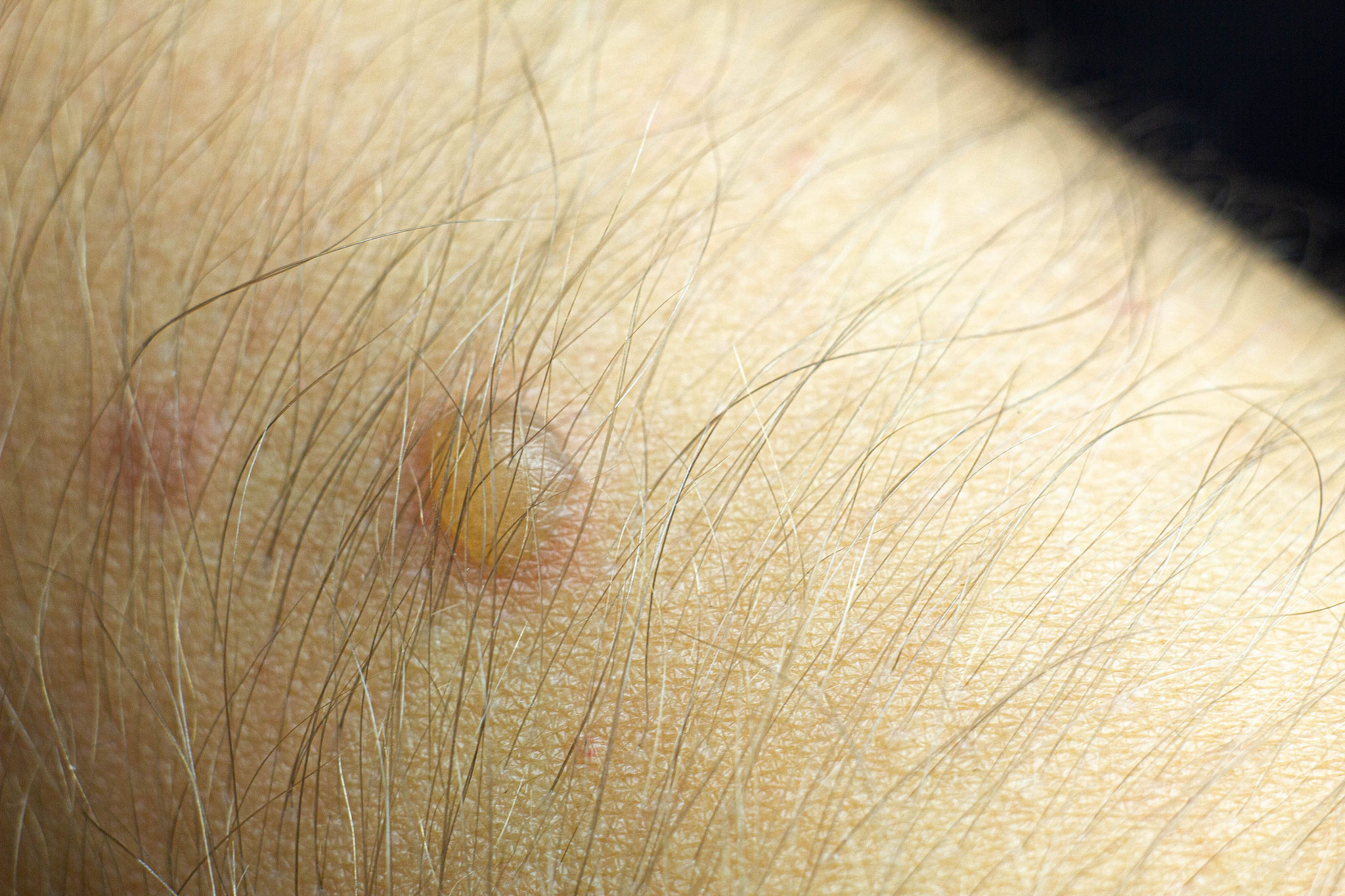 blister on the skin, burns with hot water, oil.