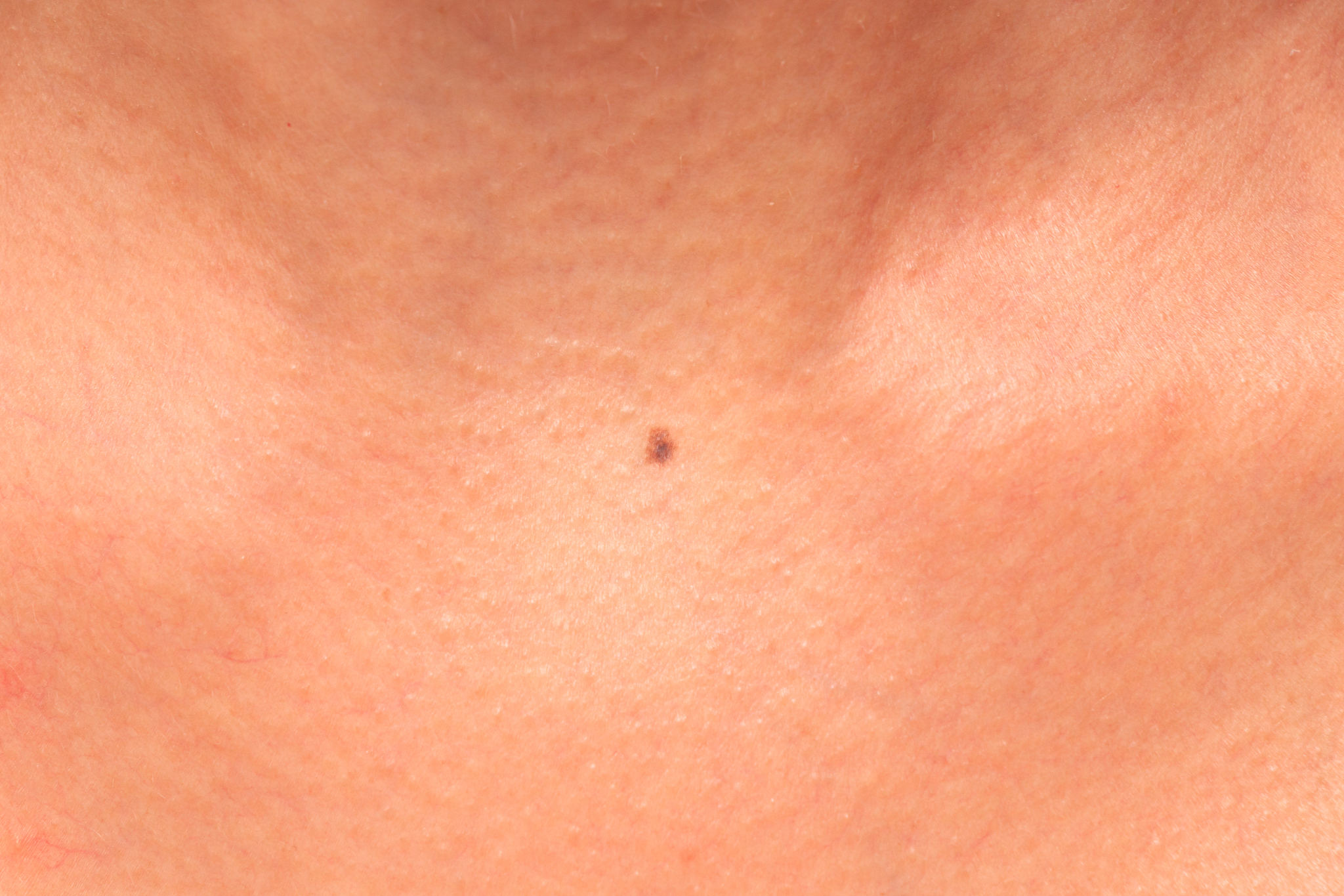 birthmark between the clavicles under the neck