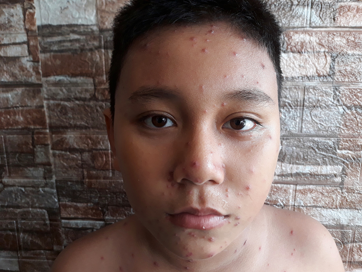 水痘得过一次还会得吗