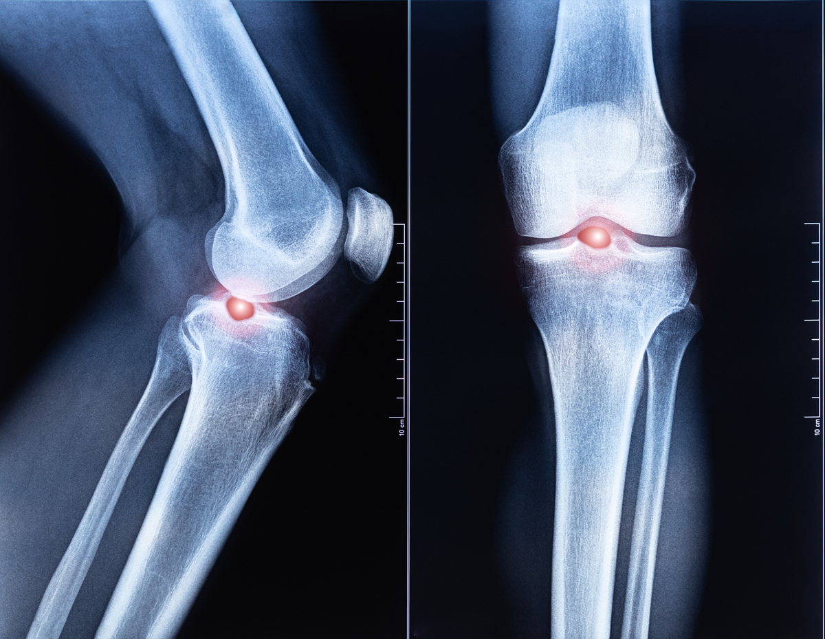 膝关节骨性关节炎