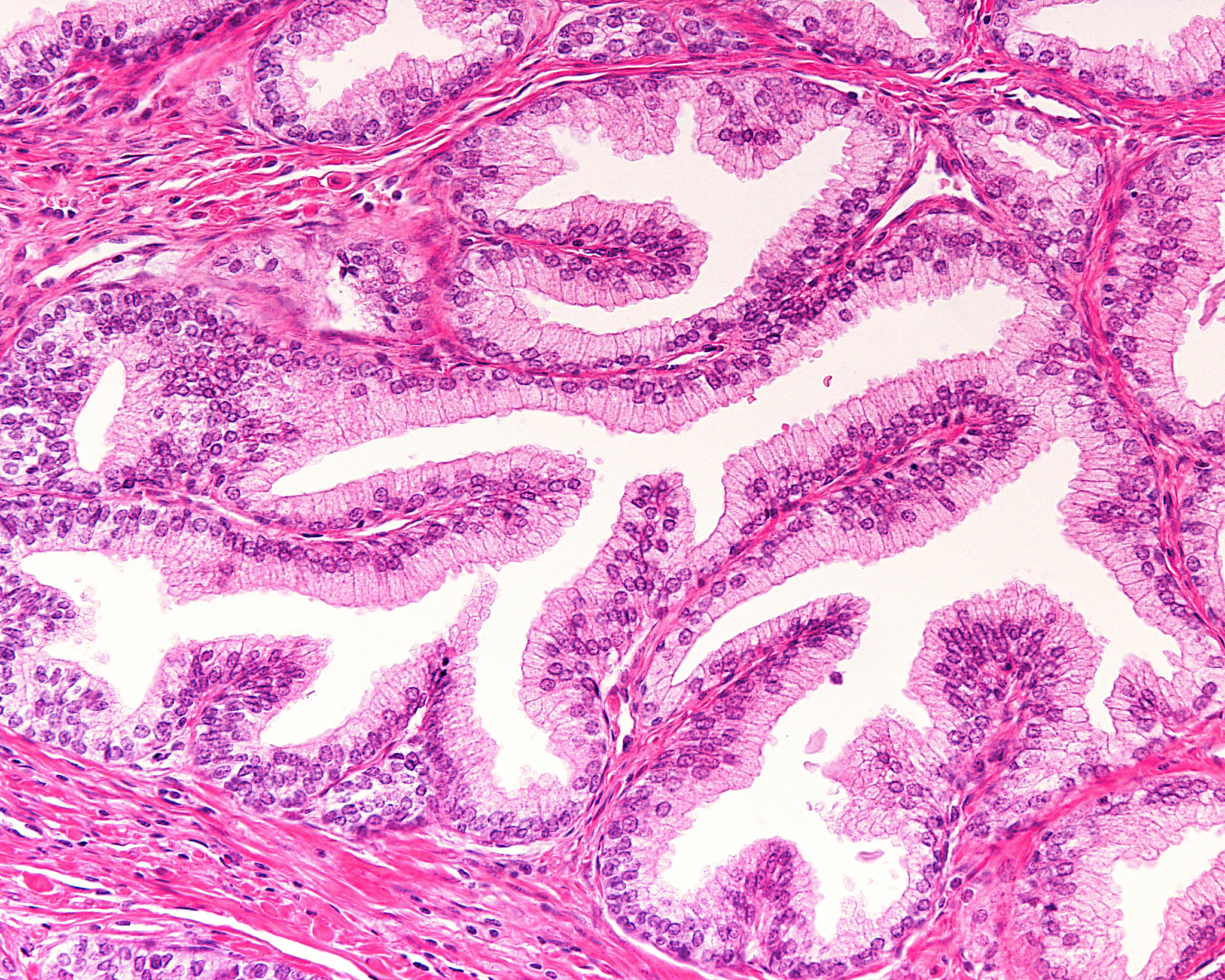 I had a few surgeries done so I know that rest and lots of ice But I am getting better day by day They suspect it to be Rheumatoid Arthritis which was caused from multiple injuries It is my immune sys