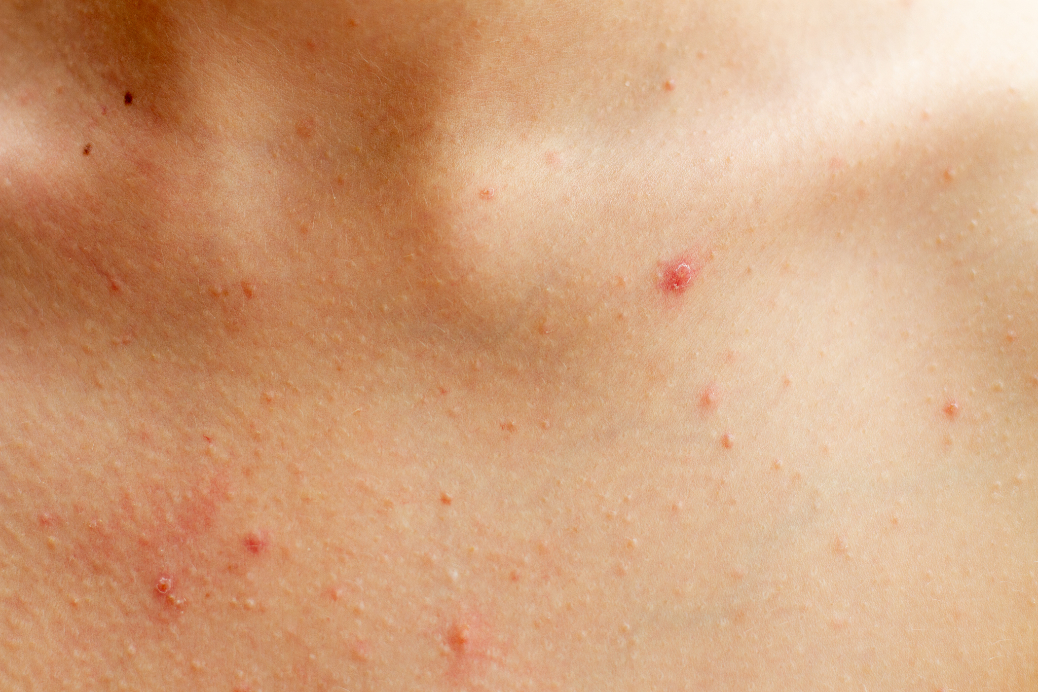 woman body with problem skin, beauty concept