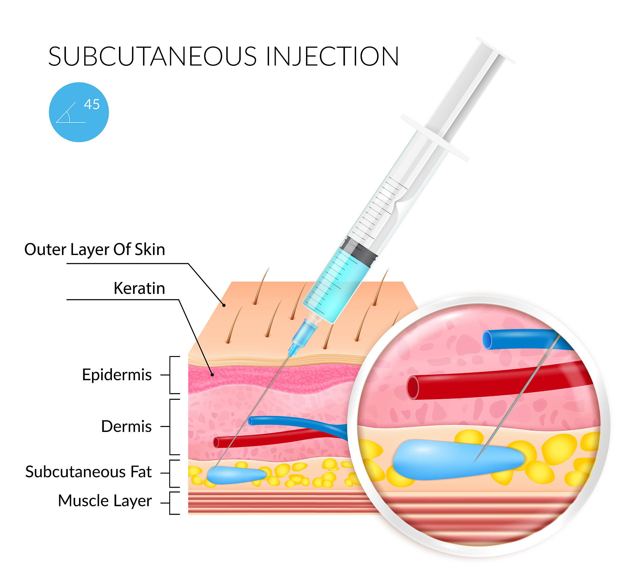来优时注射笔需要针头吗？使用指南