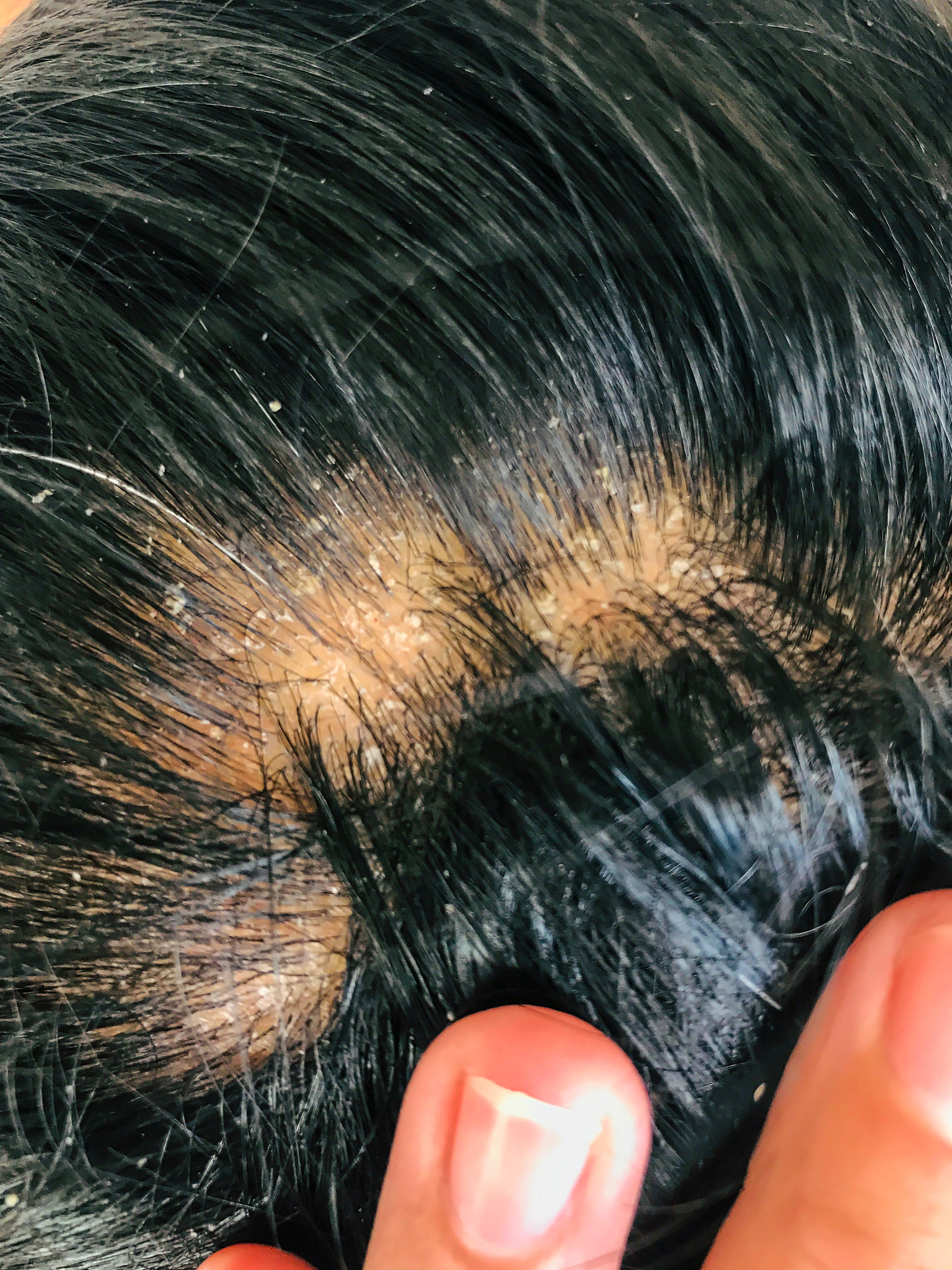 头皮屑过多？原因、症状及治疗方法 - 头皮健康指南