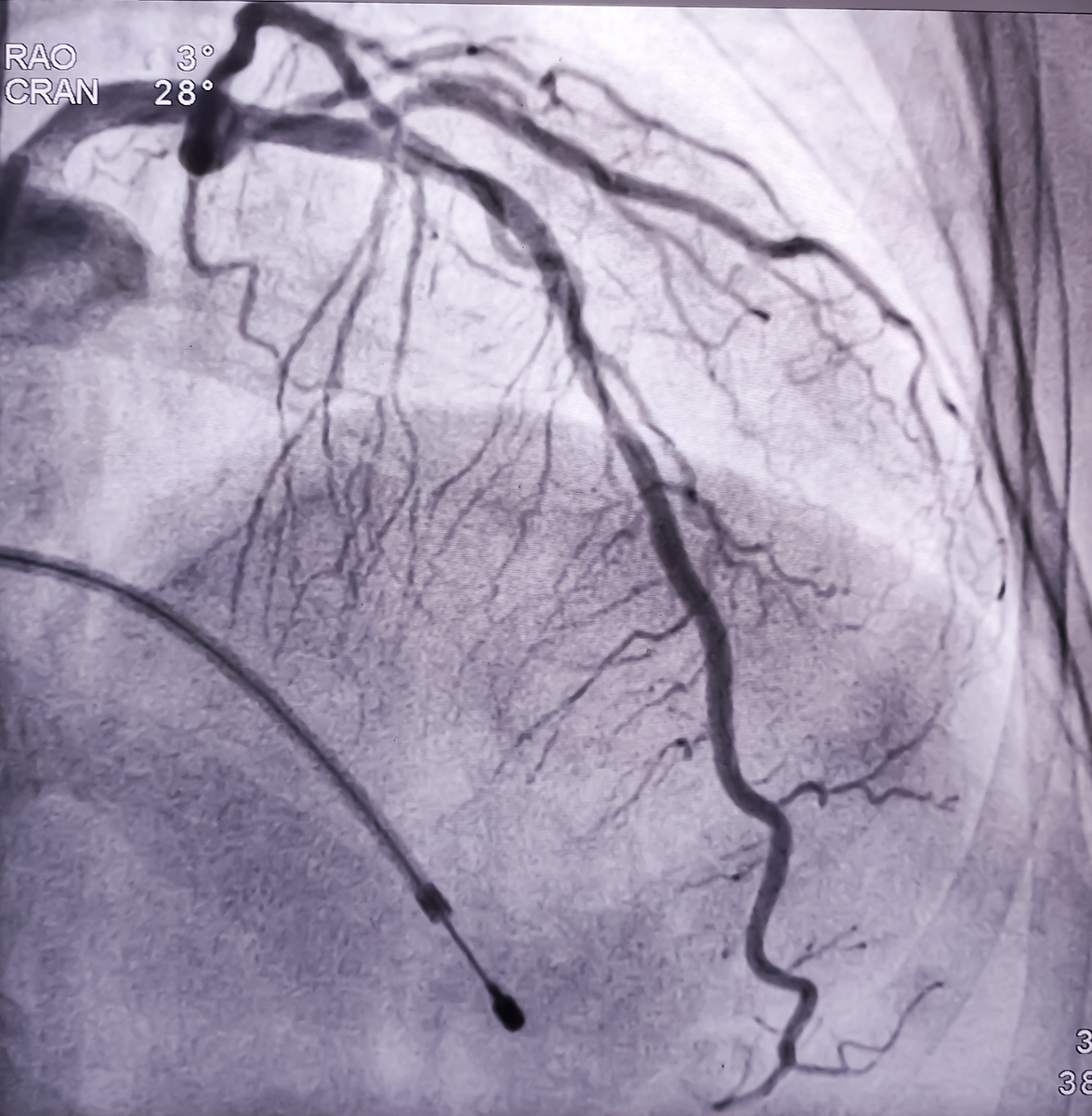 翻译：在本病例中颈动脉斑块内新生血管、斑块内小溃疡和漂浮血栓都被超声造影完美呈现CEUS精确寻找出了脑卒中的病因是颈动脉斑块破裂形成血栓患者及时进行了抗血小板治疗和支架置入术获得了良好的预后。因此急性脑卒中患者需要考虑到颈动脉易损性斑块破裂的可能性超声造影可作为一项诊断的新思路。