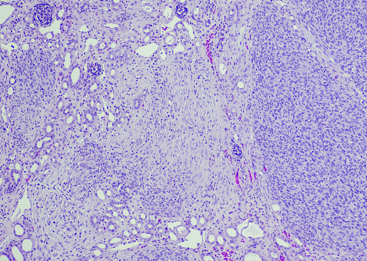 最著名的罕见病