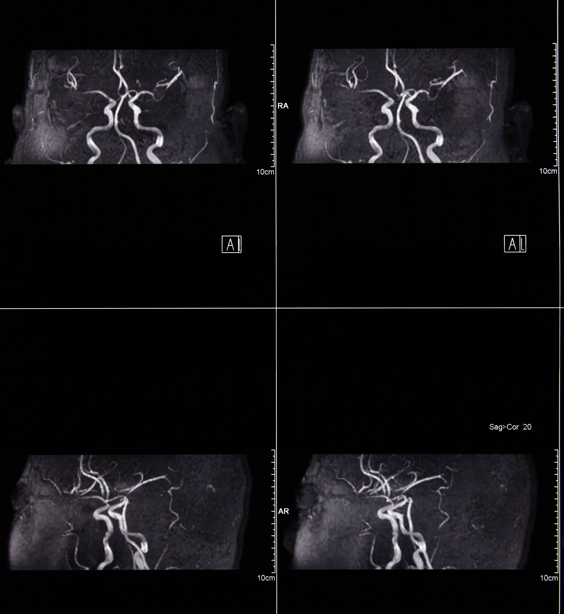 右侧颈动脉易损性斑块破裂：症状、治疗及预防