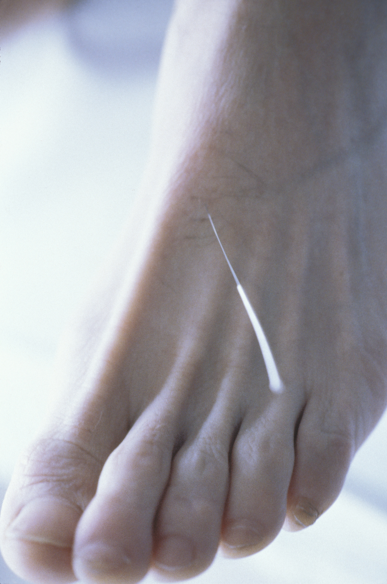 bare foot with acupuncture needle