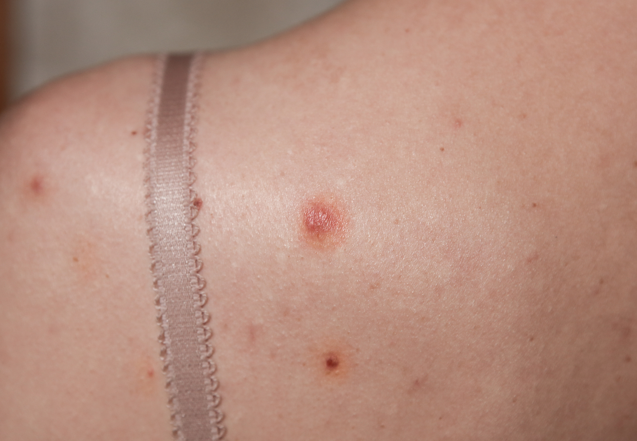 woman's oily skin with problems acne on the back. medical health
