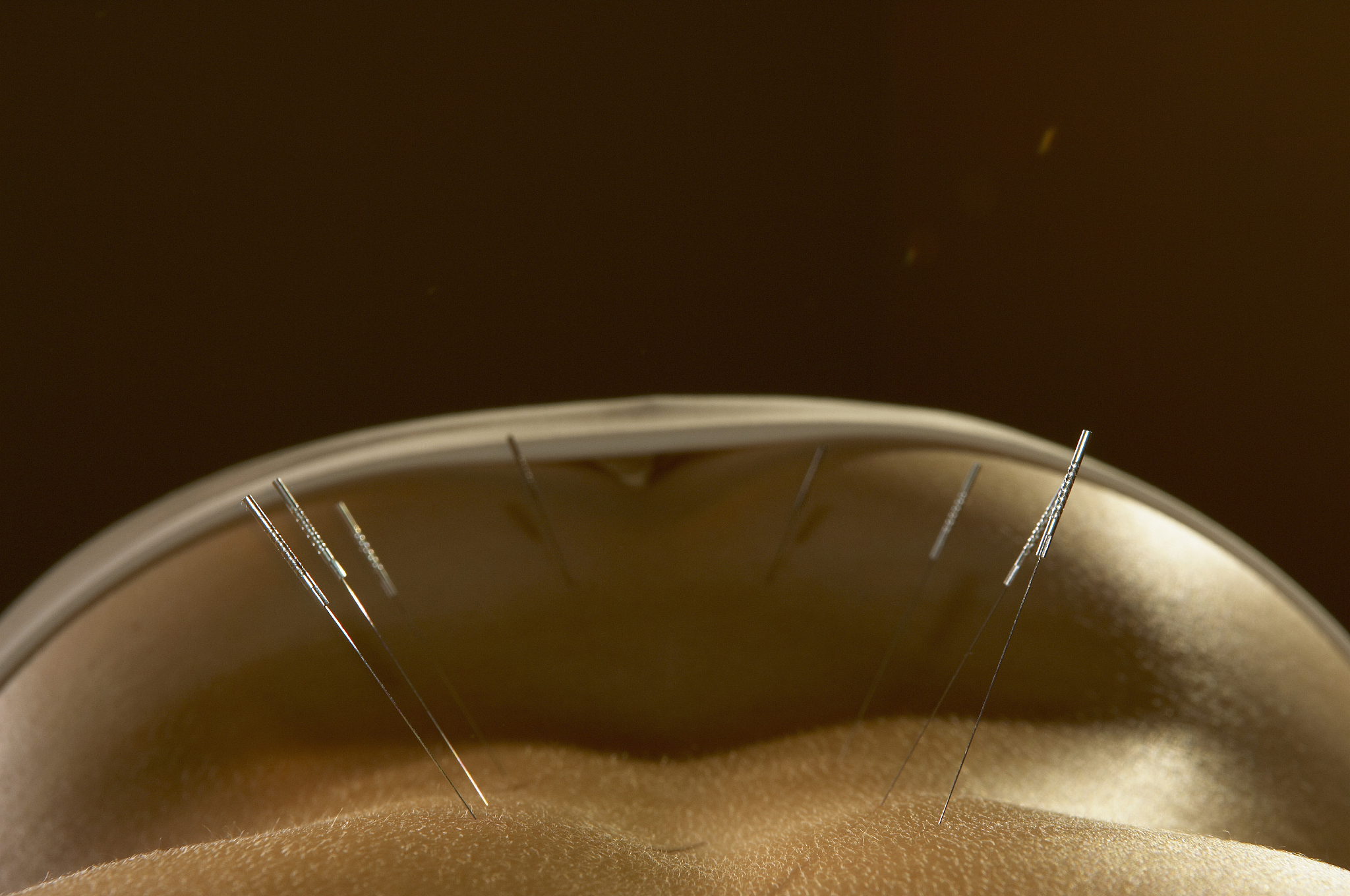 woman's lower back having acupuncture, close-up