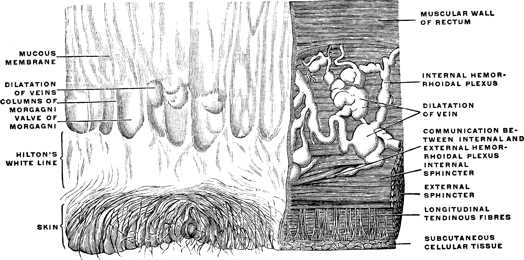 多孔介质裂隙中的椭圆细颈喉道和裂喉：定义、类型与影响