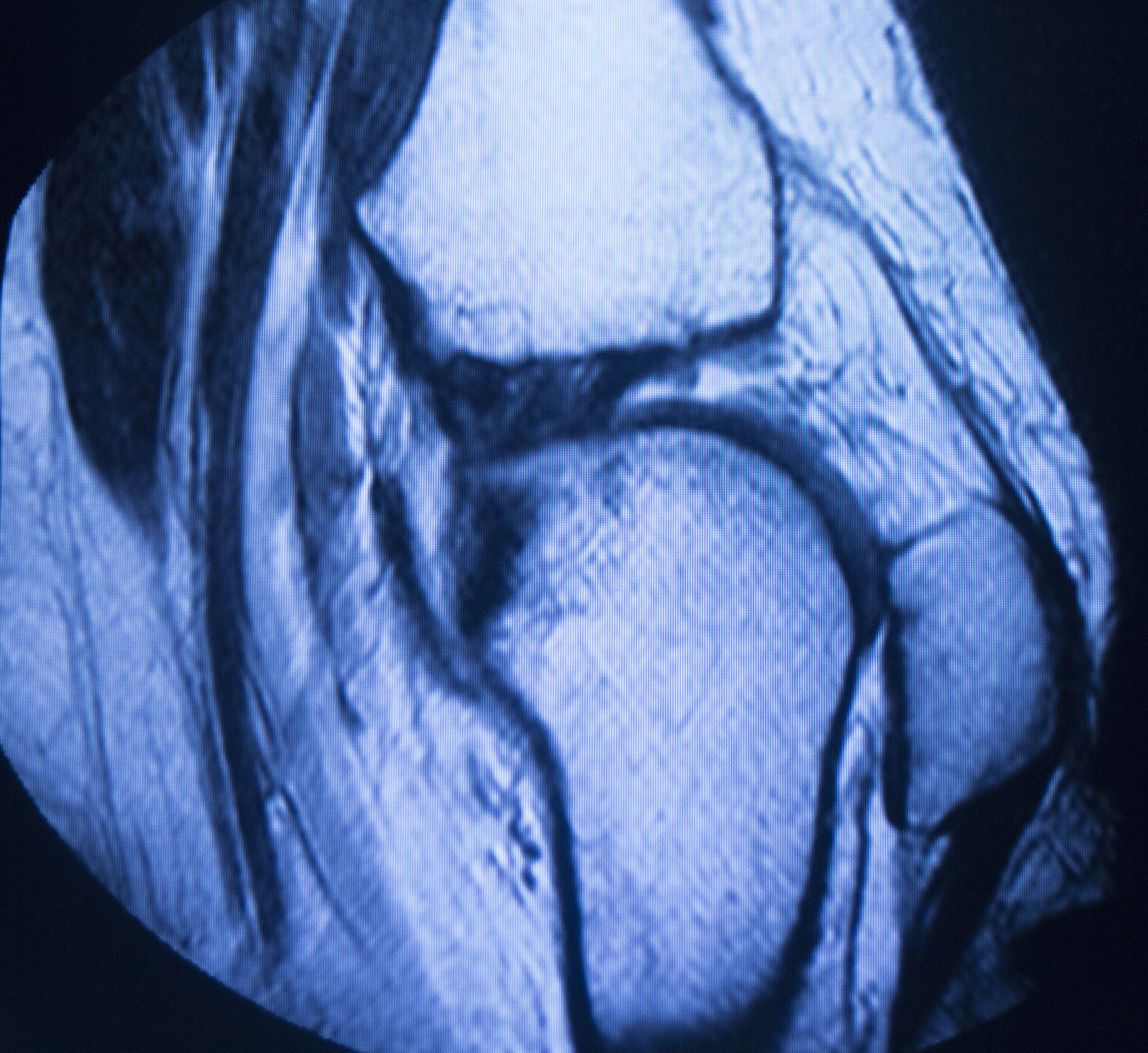 韧带损伤MRI分级：Ⅰ级、Ⅱ级、Ⅲ级分别代表什么？