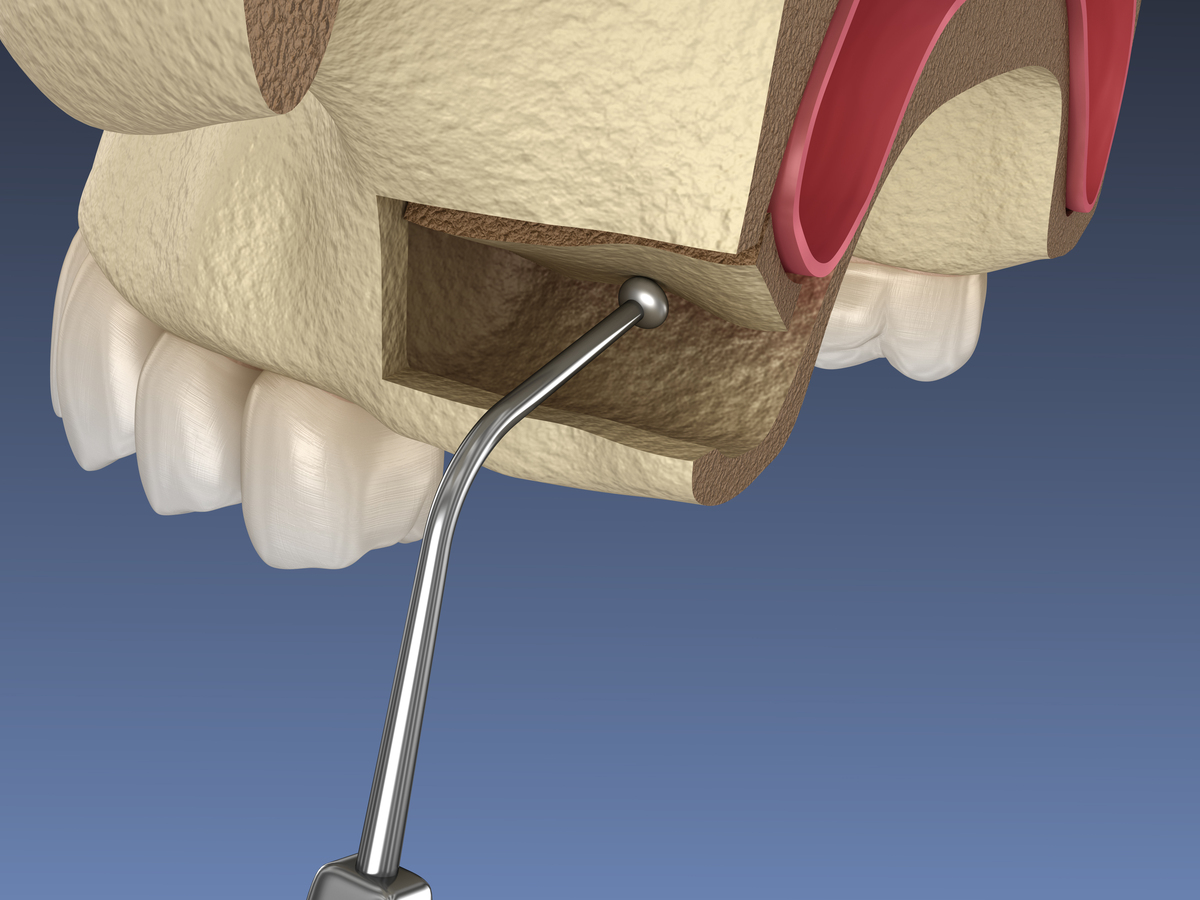可以翻译这段话吗Osseous repair or botie fill of infrabonypockets has been reported by a number ofauthors as a sequel to various periodontaltreatment procedures Prichard 1957 Schallhorn 1967 Robinson 1969 Rose