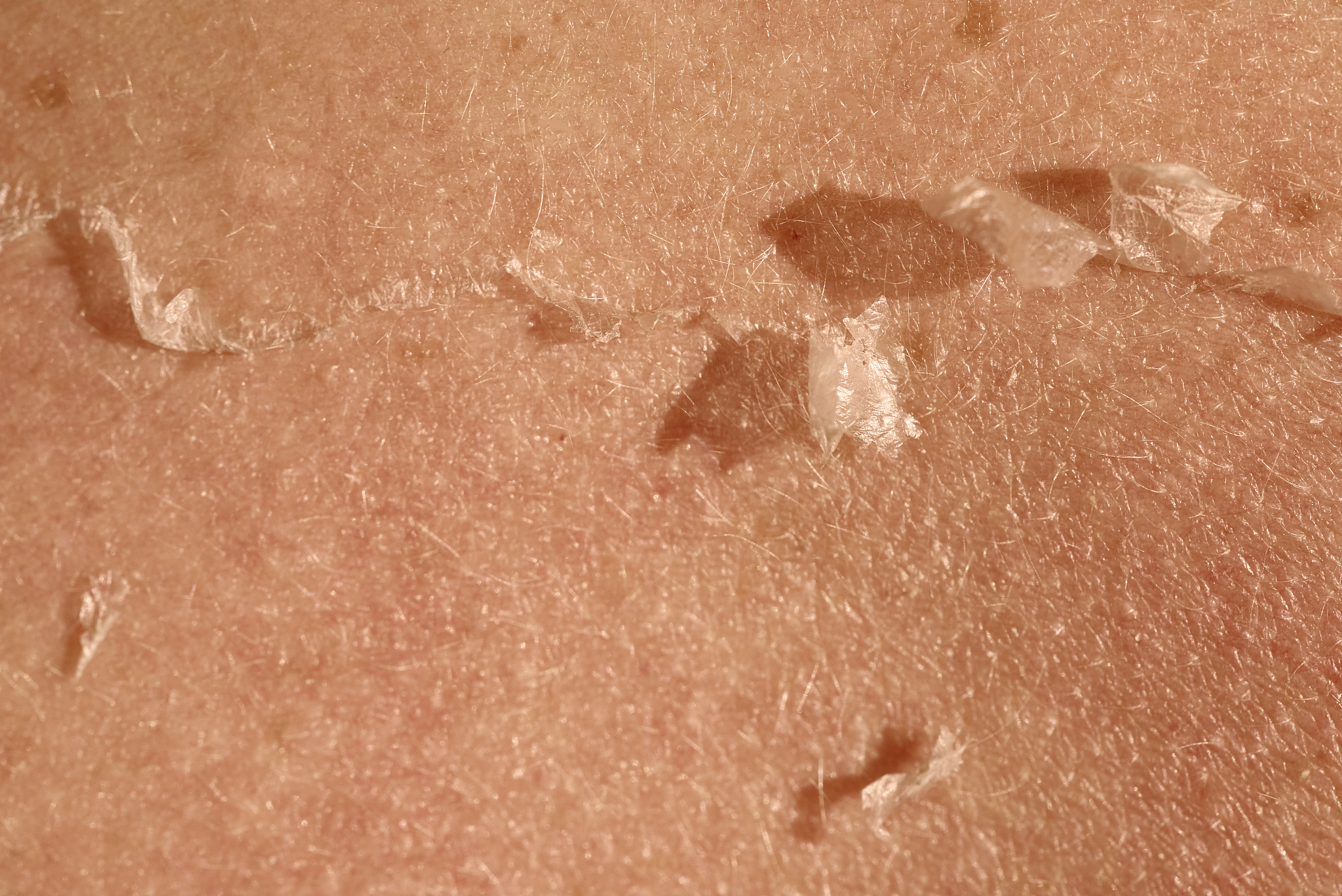 皮肤里有螨虫怎么治疗？