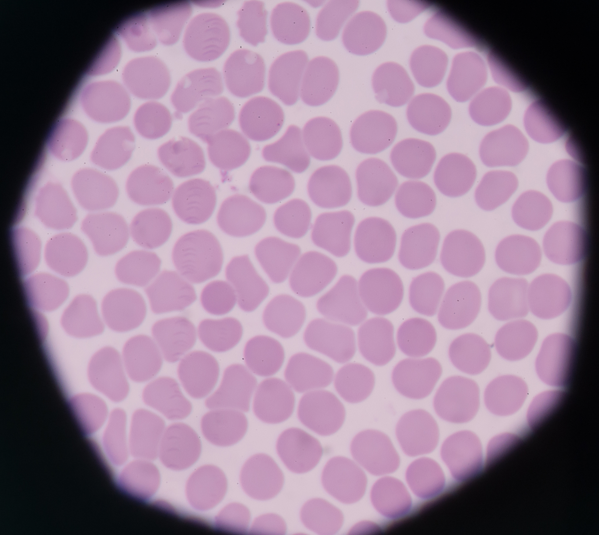 血小板在血涂片中难以观察的原因