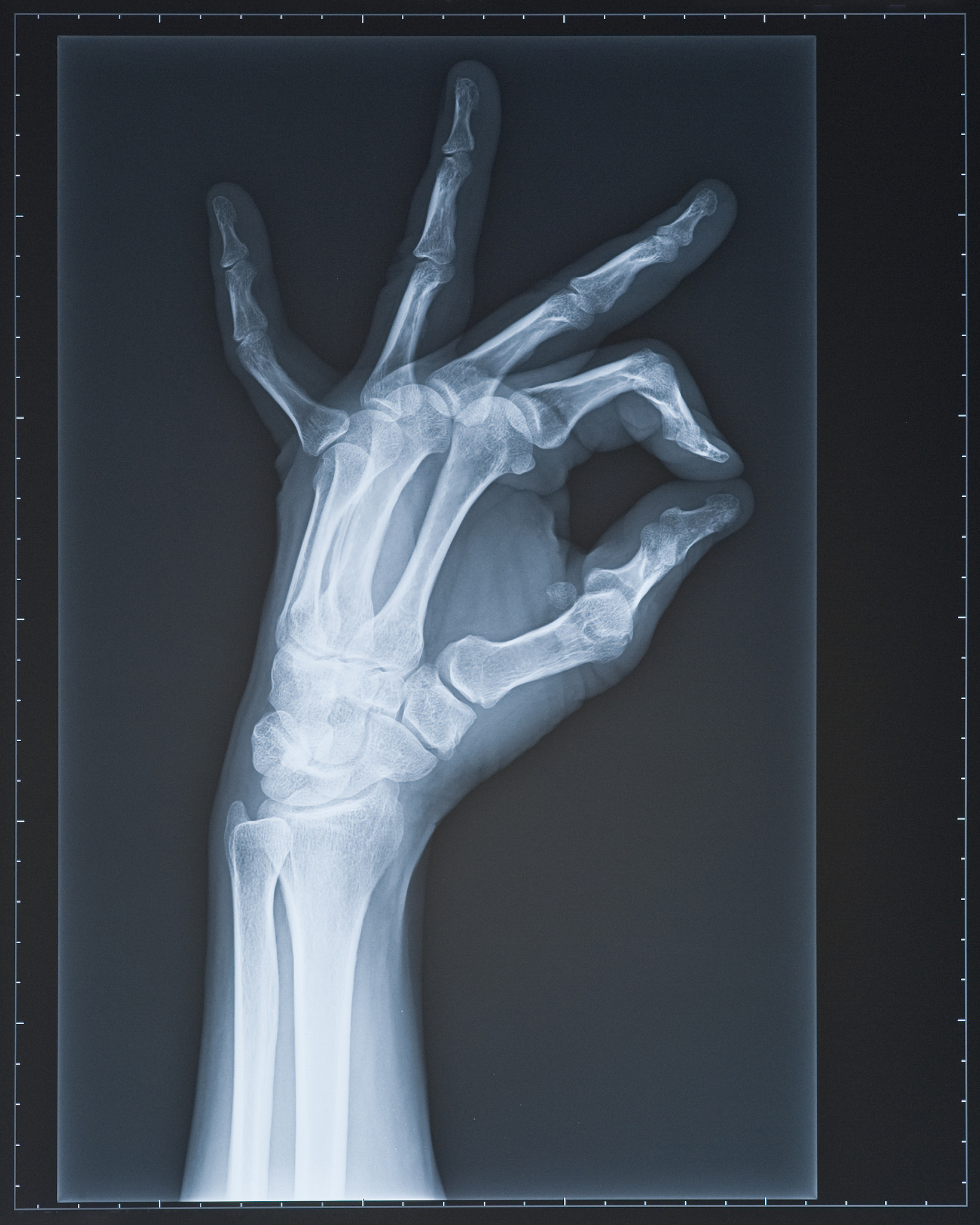 尺骨桡骨如何运动？详解前臂旋转机制